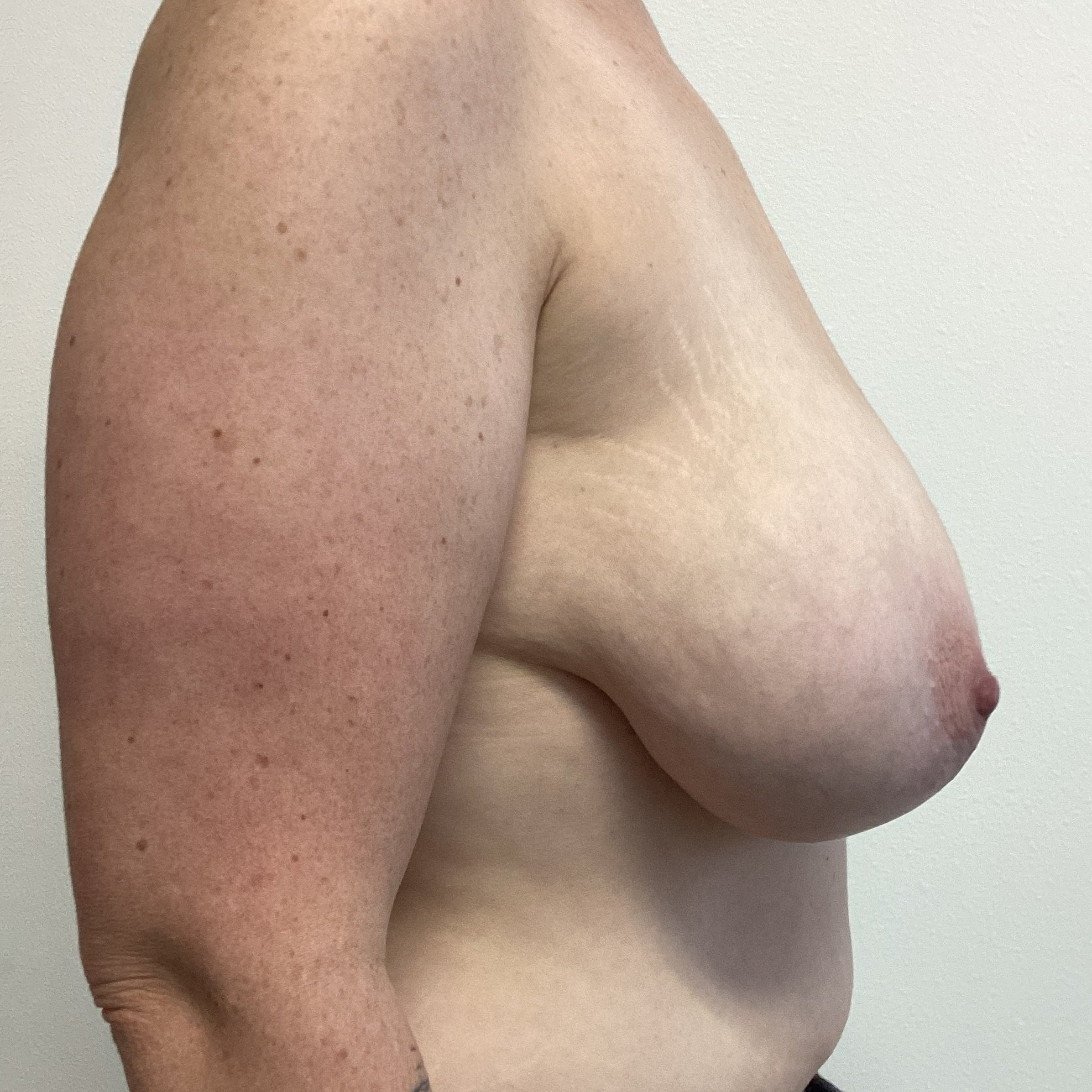 breast-lateral-right-01.25.2022-29413840.jpg