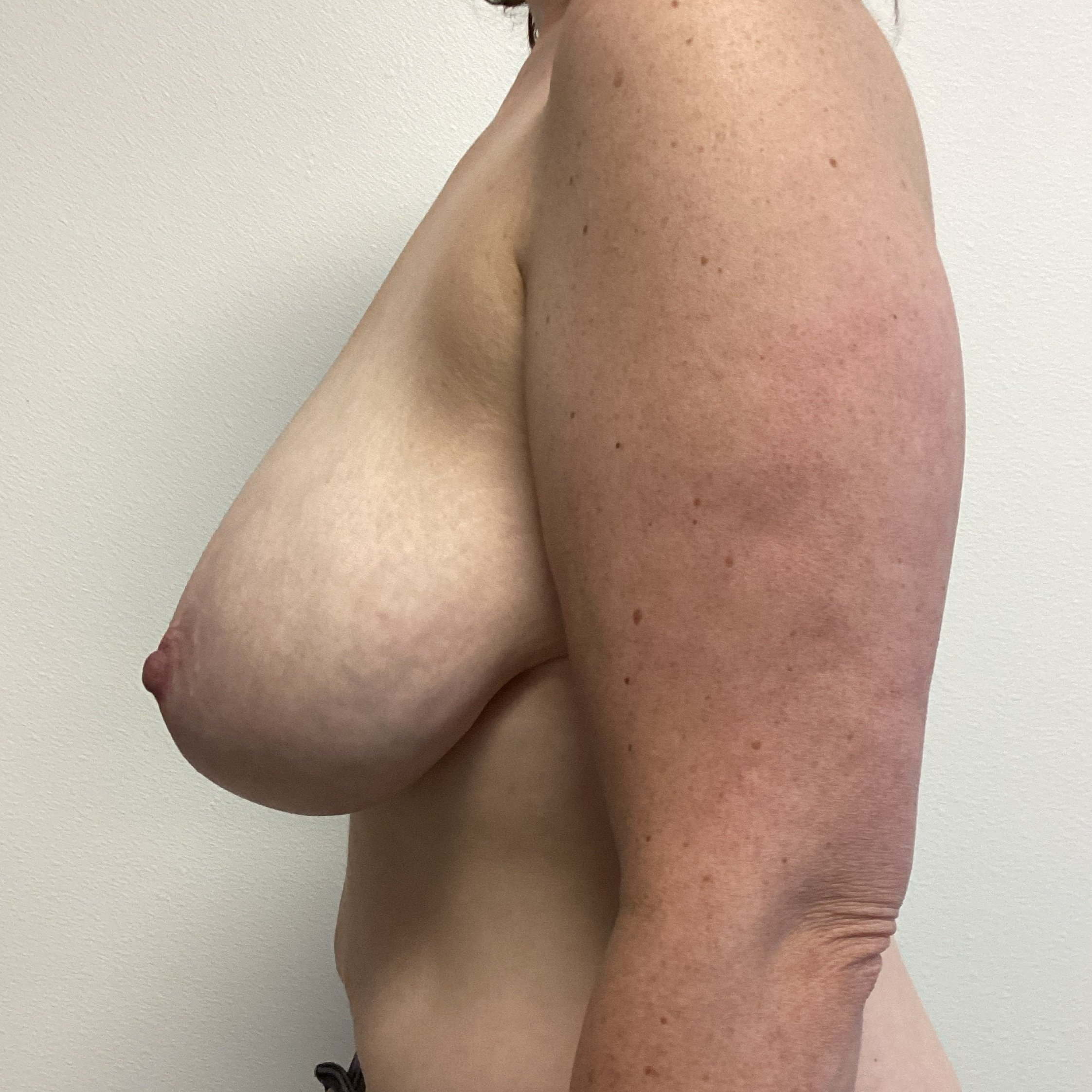 breast-lateral-left-01.25.2022-29413825.jpg