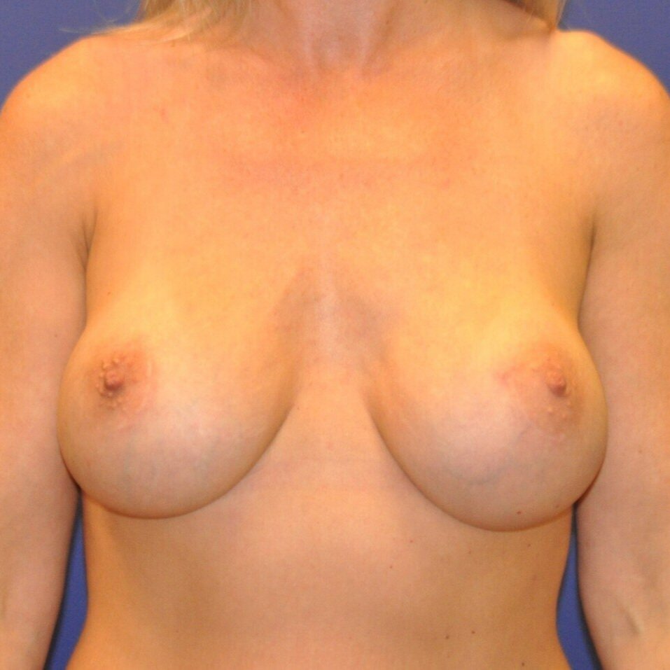 After Saline Implant Removal, Capsulectomy and Exchange of Implants