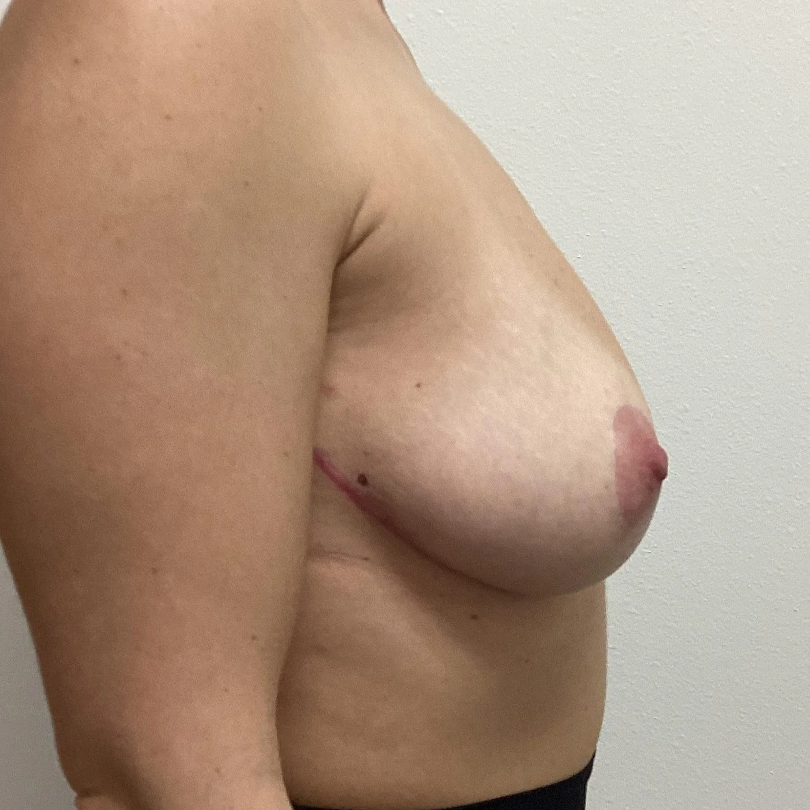 After Bilateral Implant Removal and Lower Pole Mastopexy