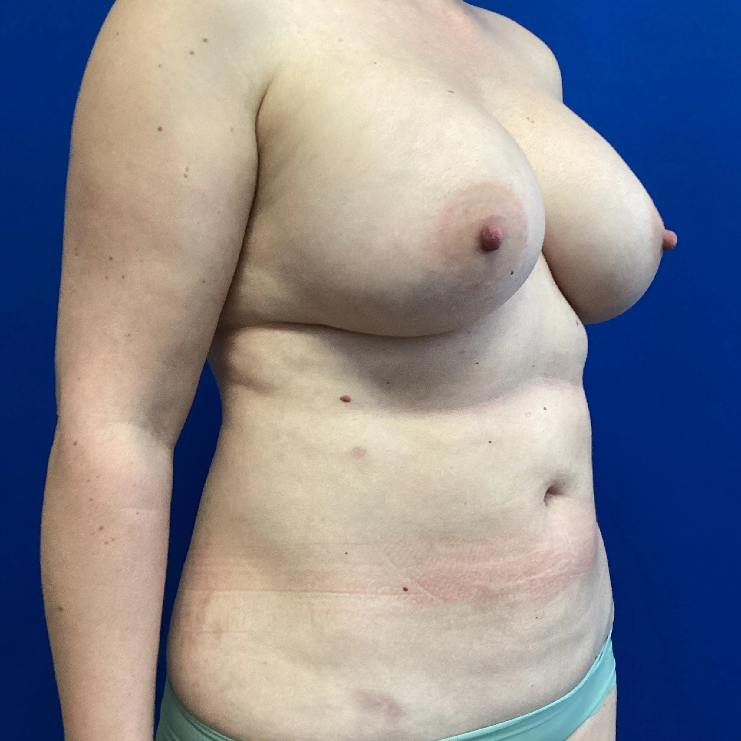After Liposuction of Abdomen Renuvion
