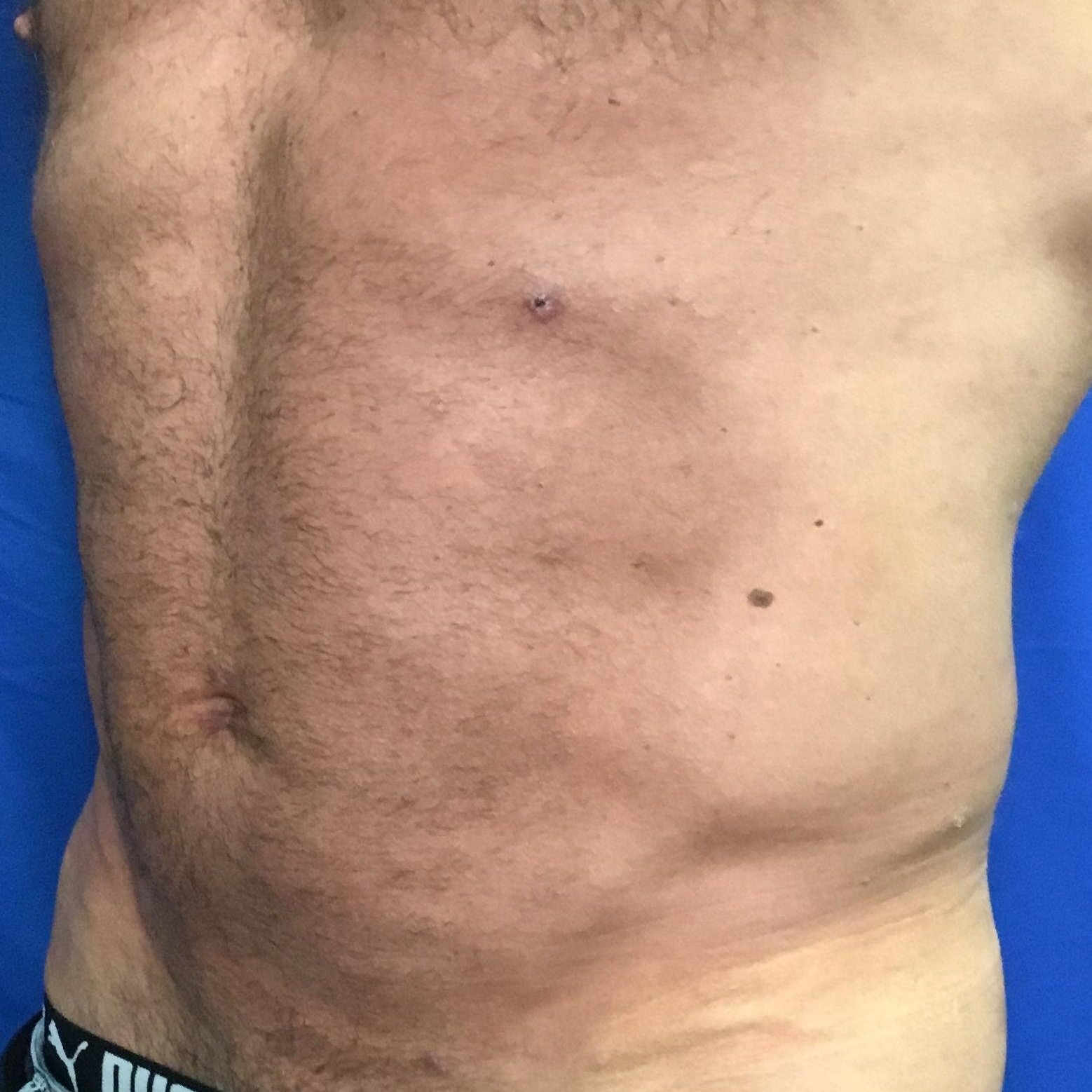 After Liposuction of Abdomen with U-Grafting and Renuvion Ab Etching