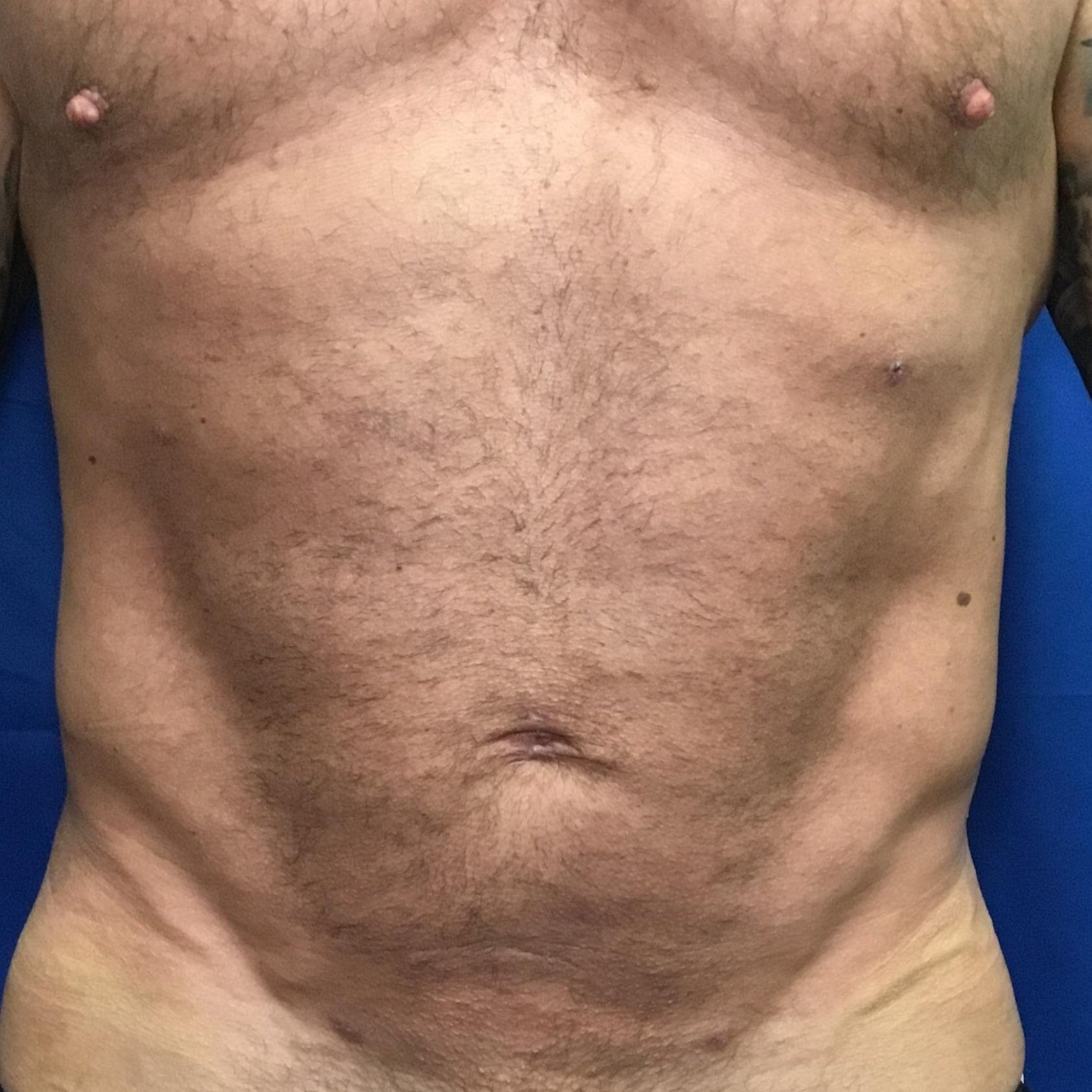 After Liposuction of Abdomen with U-Grafting and Renuvion Ab Etching