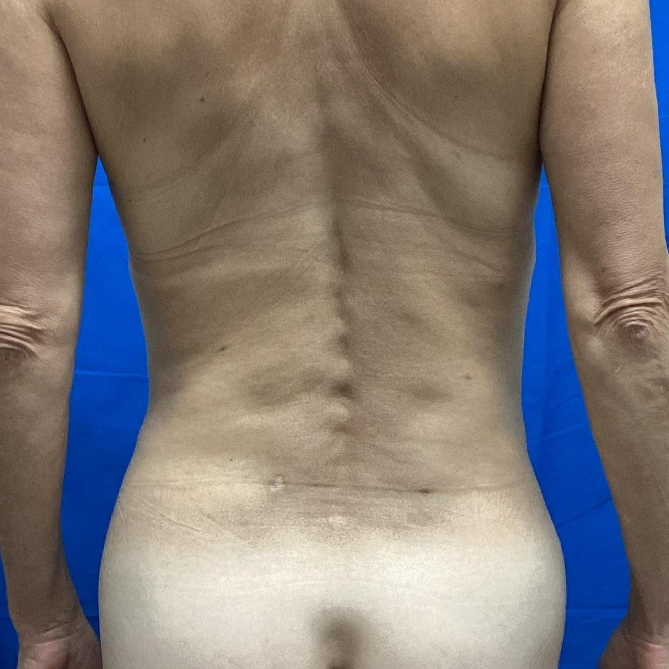 After Liposuction of Flanks with Renuvion