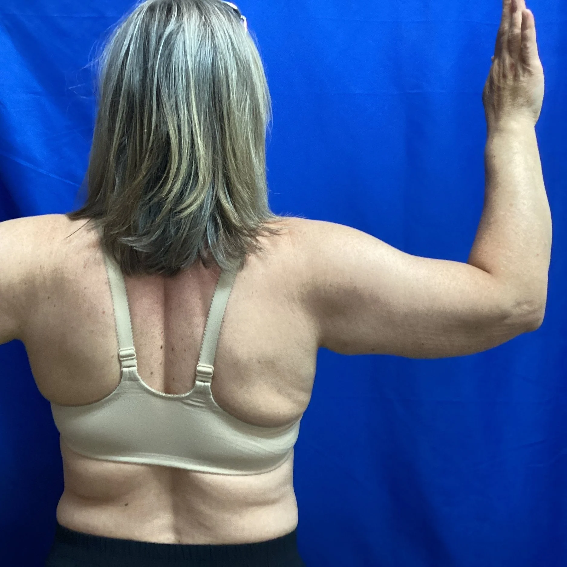 After Liposuction and Renuvion of Arms