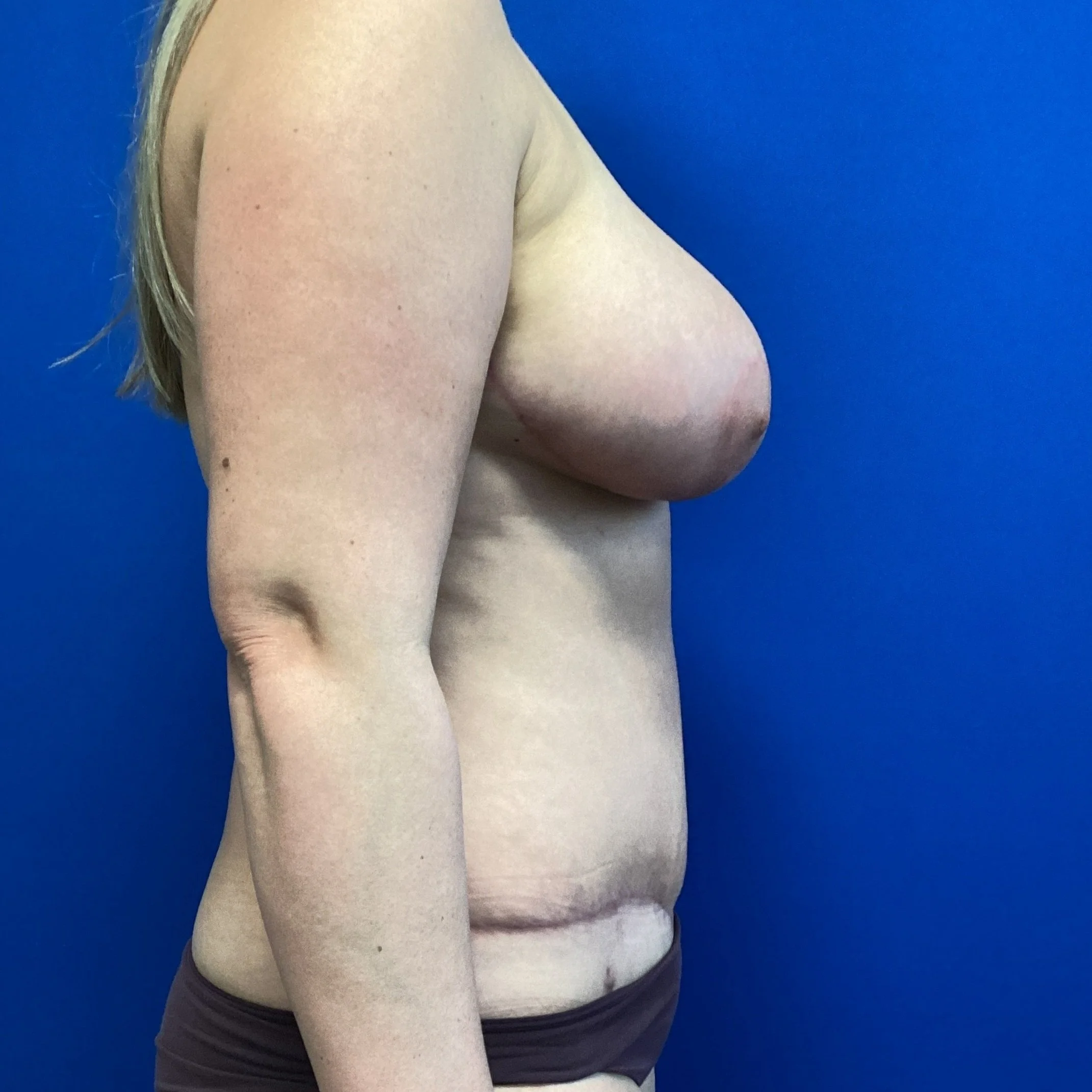 tram-posterior-oblique-left-02.17.2022-30269942.jpg