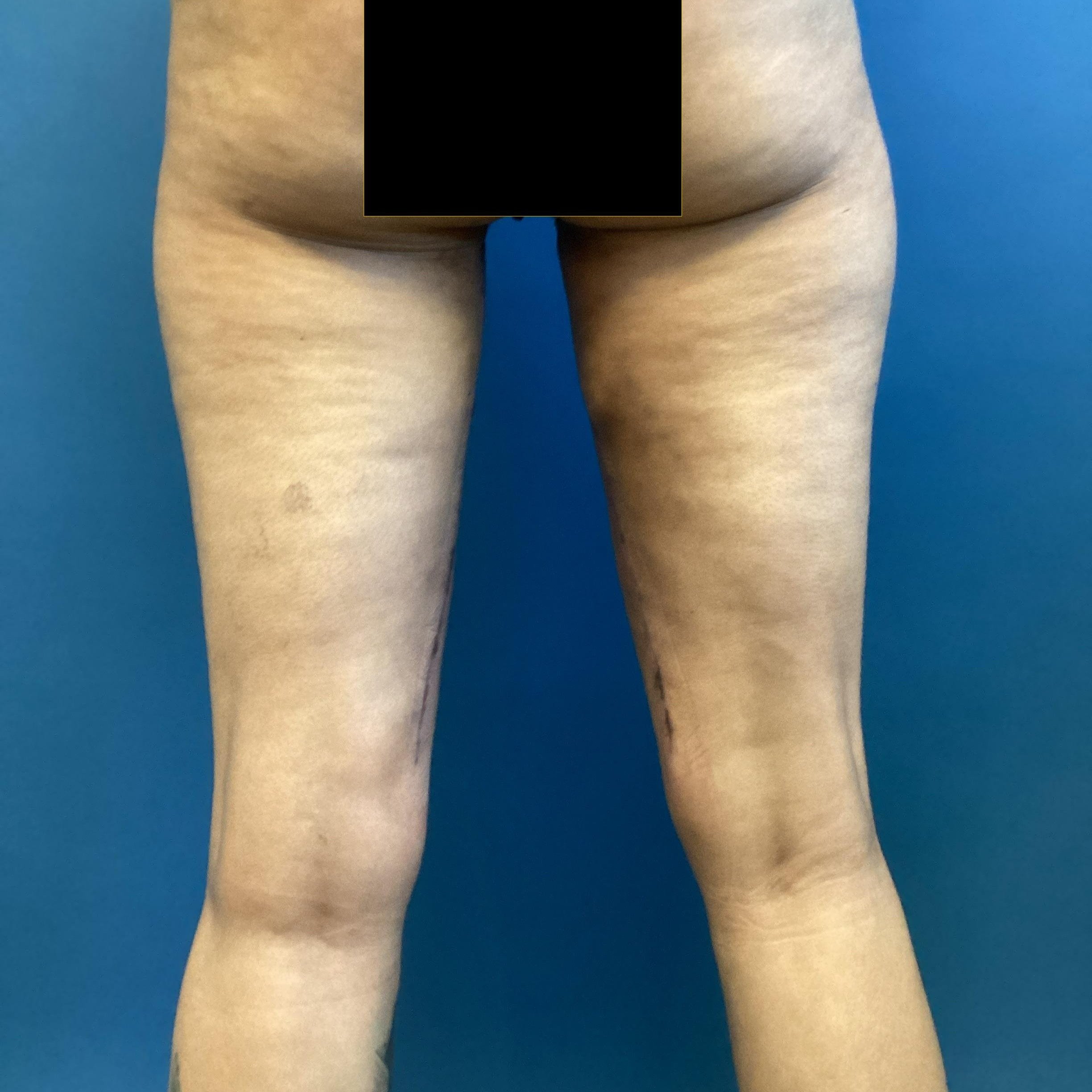 legs-posterior-oblique-left-01.10.2023-45869839.jpg
