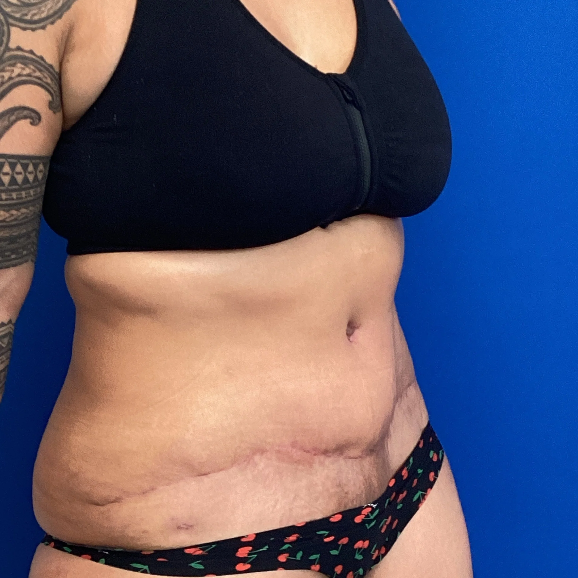 abdomen-anterior-oblique-right-06.23.2022-35411563.jpg