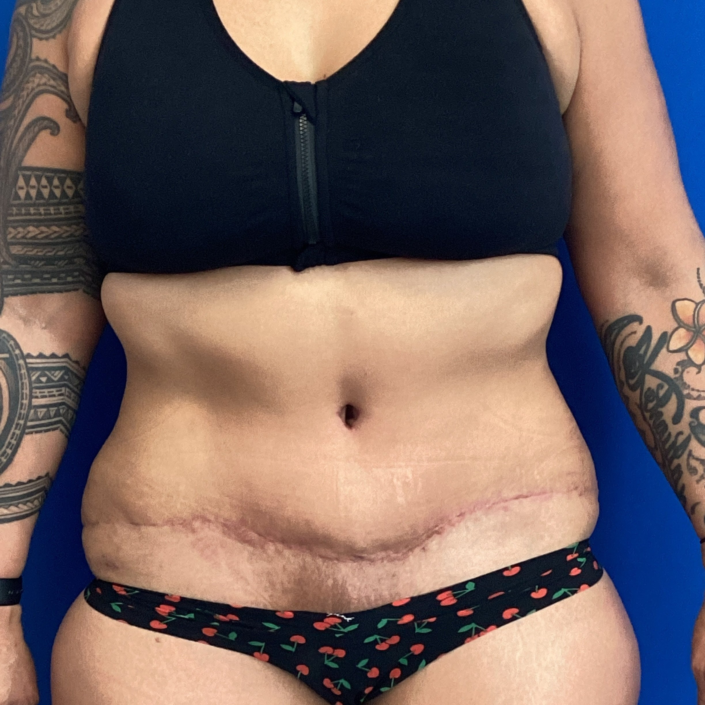 abdomen-anterior-06.23.2022-35411538.jpg