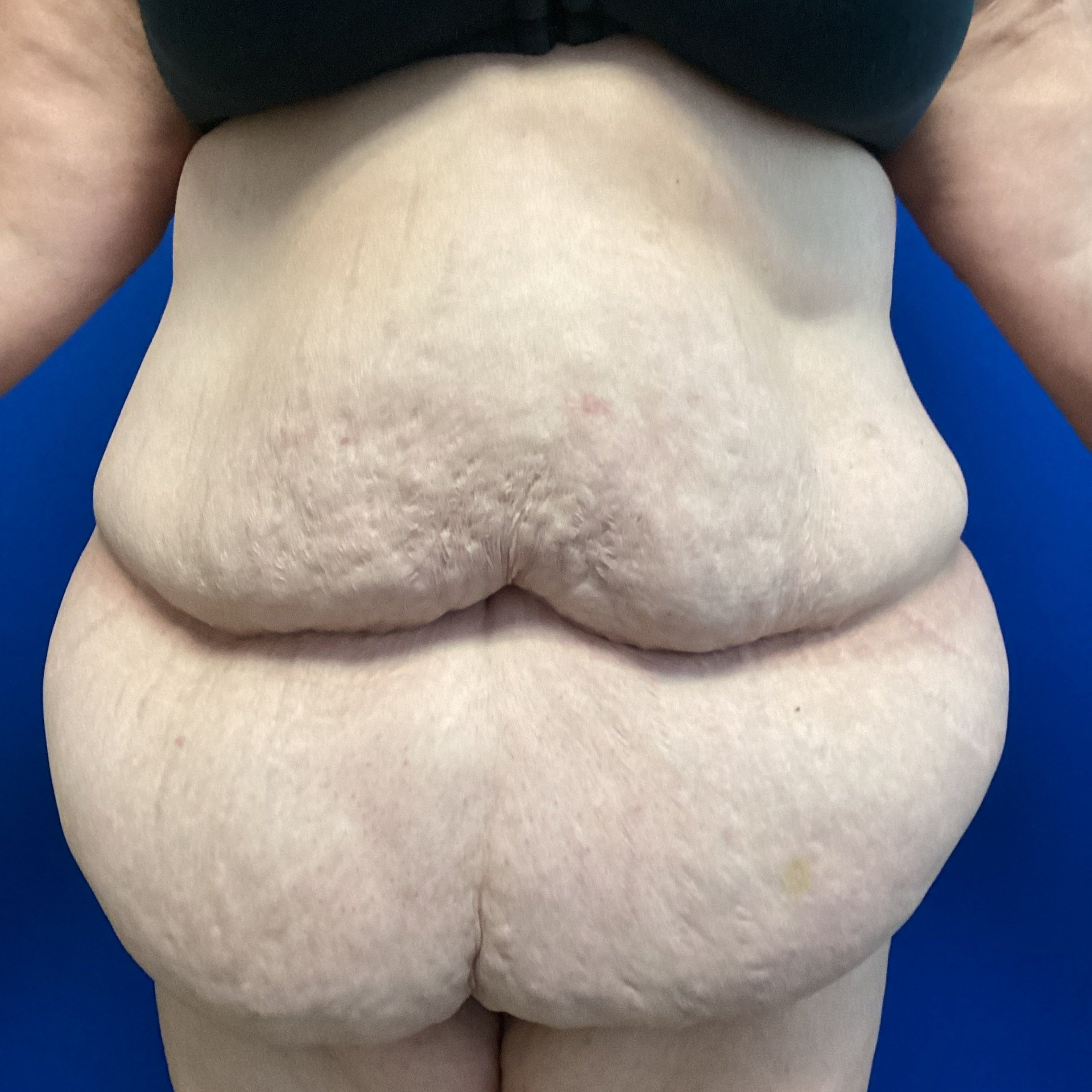 abdomen-anterior-oblique-left-09.27.2022-39100565.jpg