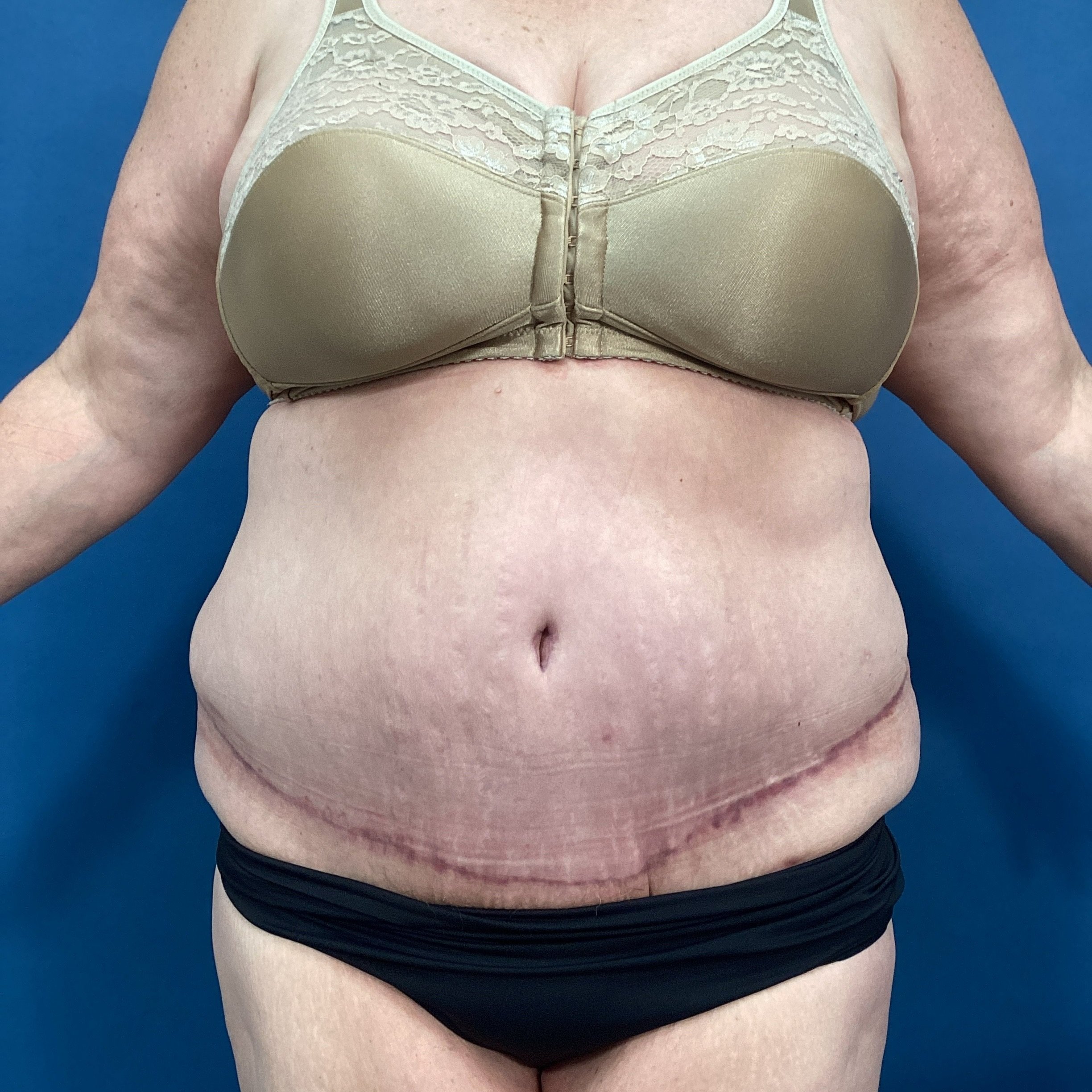 abdomen-anterior-01.24.2023-44611097.jpg