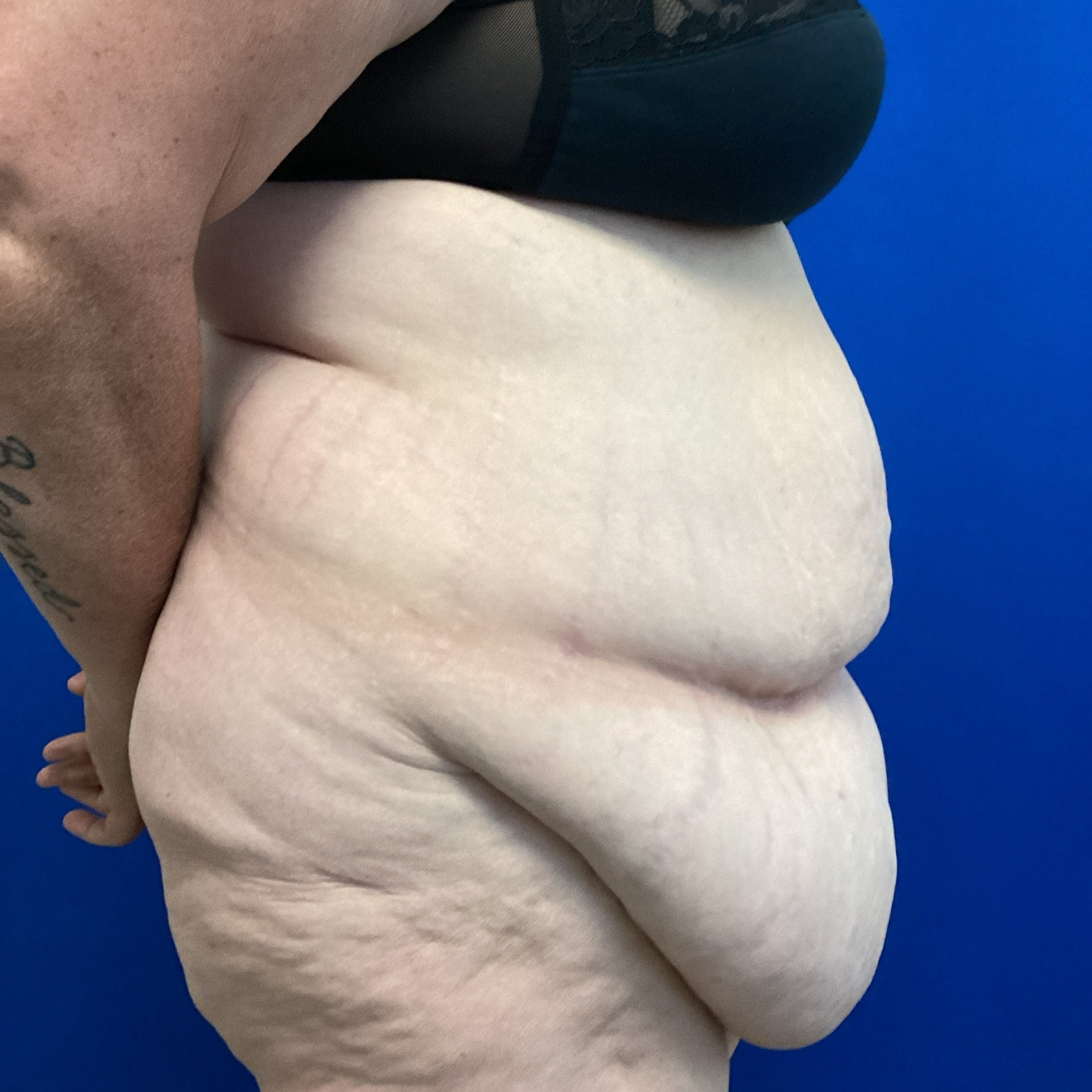 abdomen-posterior-oblique-right-09.27.2022-39100642.jpg