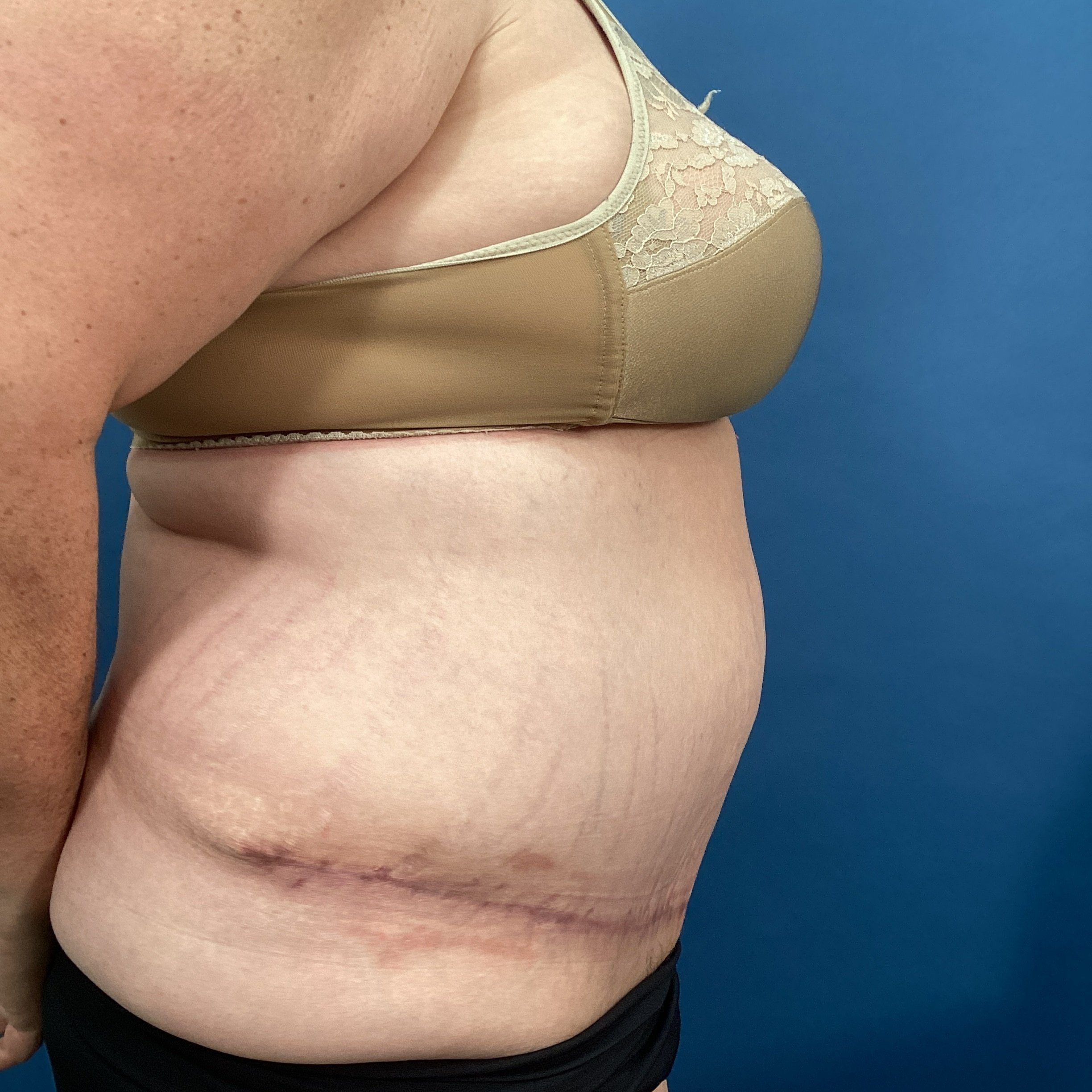 abdomen-posterior-oblique-left-01.24.2023-44611152.jpg