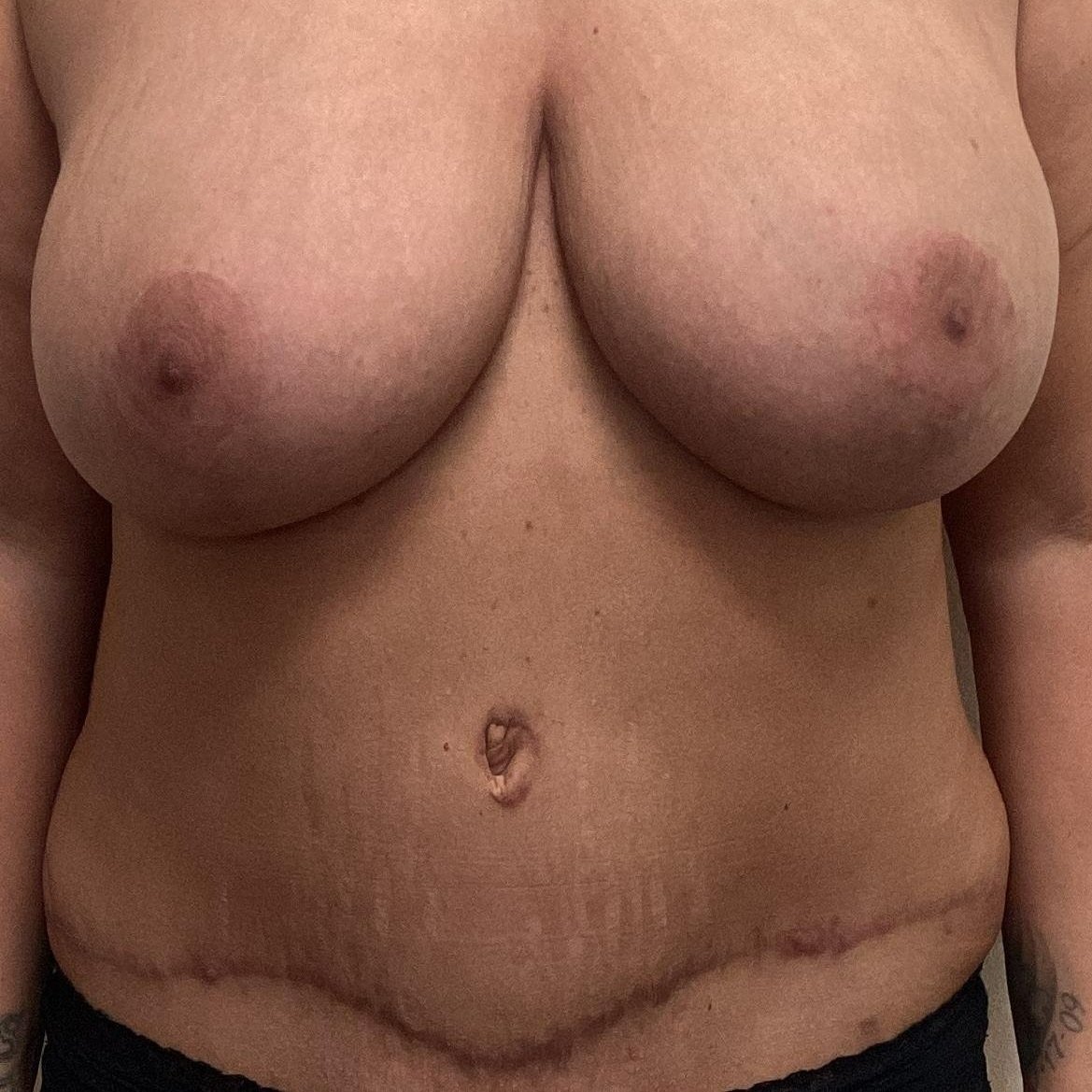 abdomen-anterior-05.24.2022-34250921.jpg