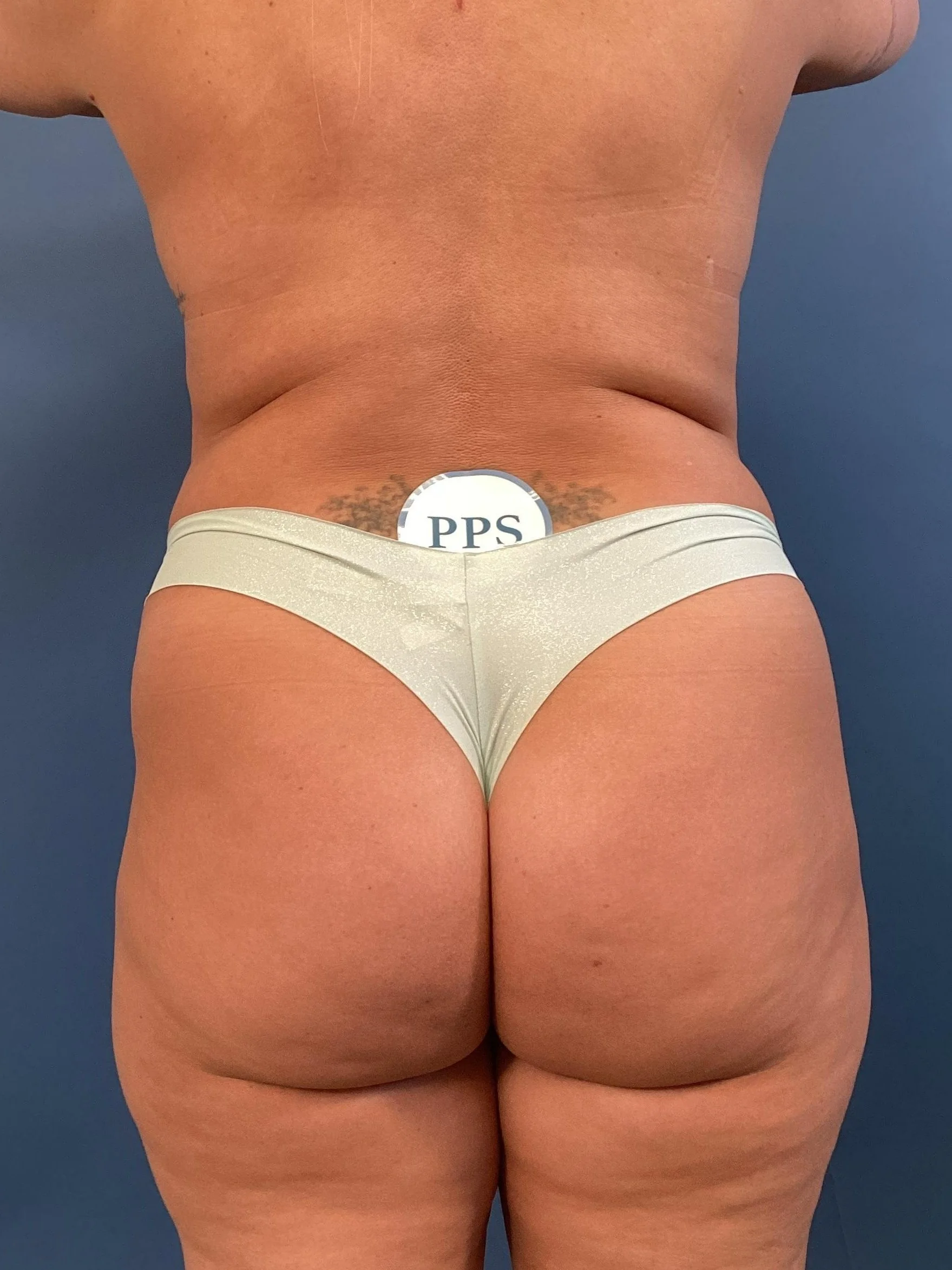 Olympia Washington Brazilian Butt Lift Surgery