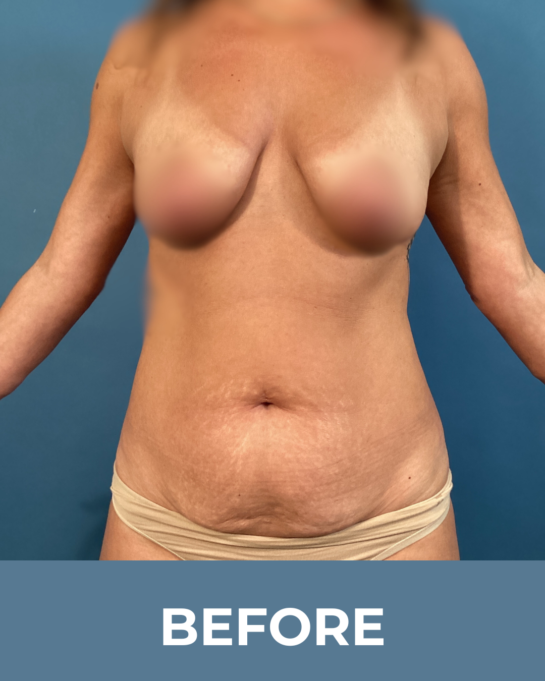 6 weeks postop Breast Lift + Fat grafting & extended abdominoplasty1.png