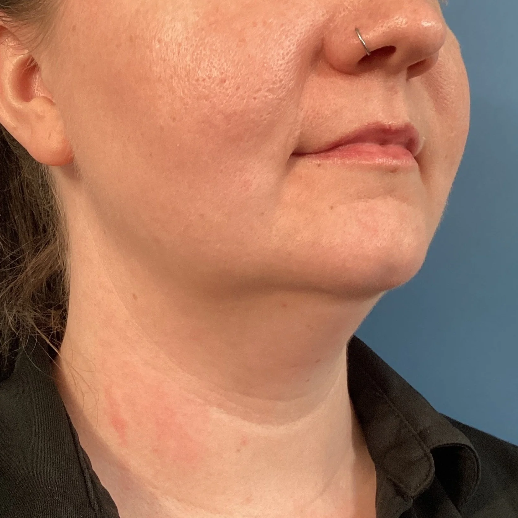 neck-landscape-anterior-oblique-right-07.16.2024-72664150.jpeg