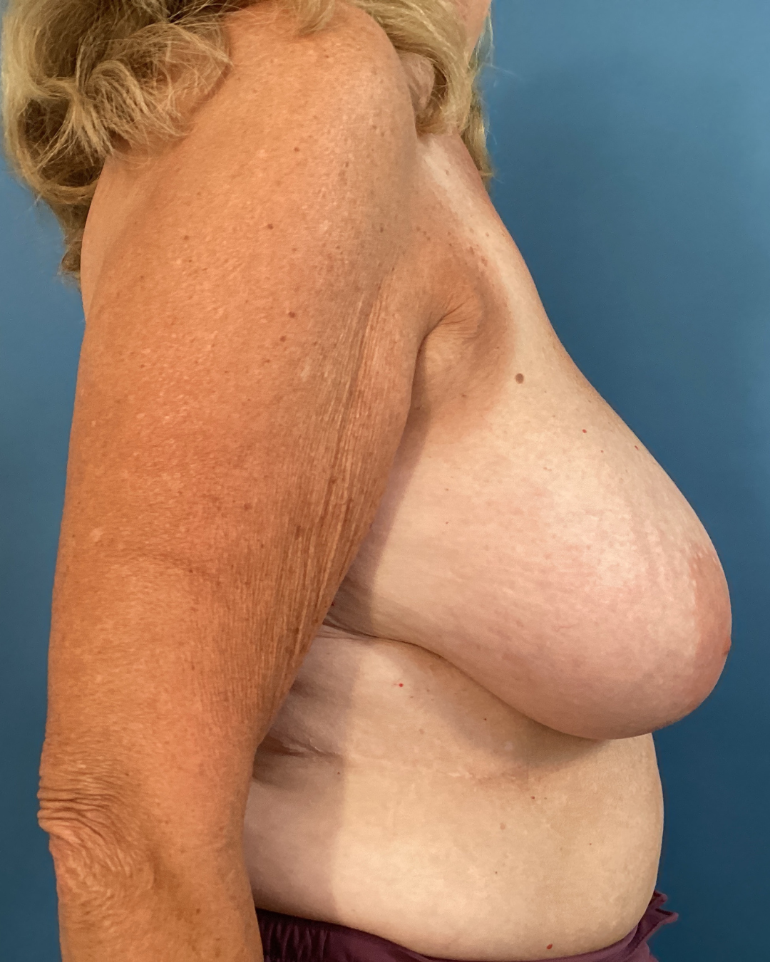 website bilateral breast reduction 3.png