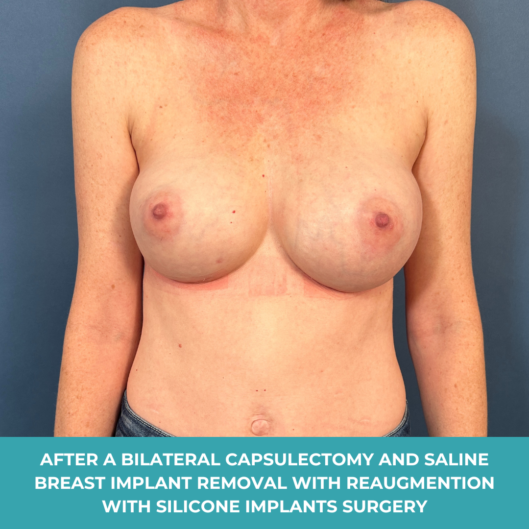 4 months post op bilateral breast augmentation2.png