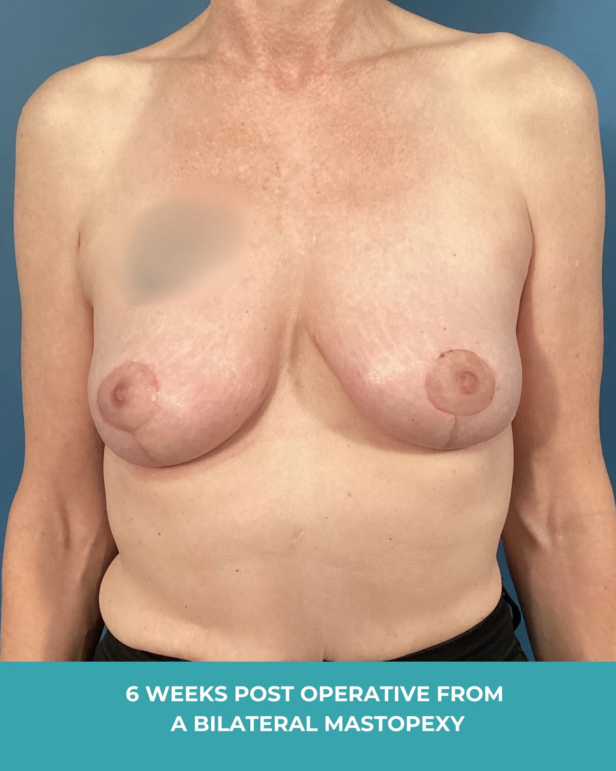 6 weeks post operative from  a bilateral mastopexy2.jpg