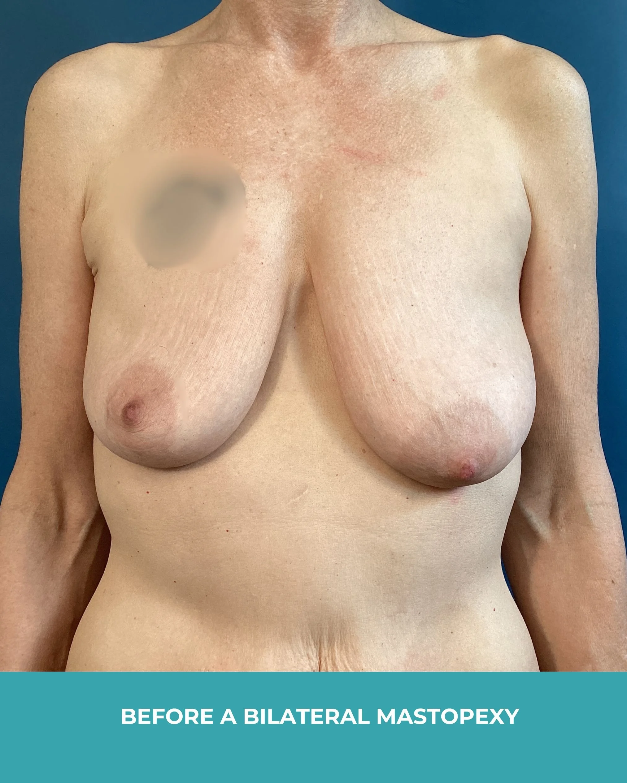 6 weeks post operative from  a bilateral mastopexy1.jpg