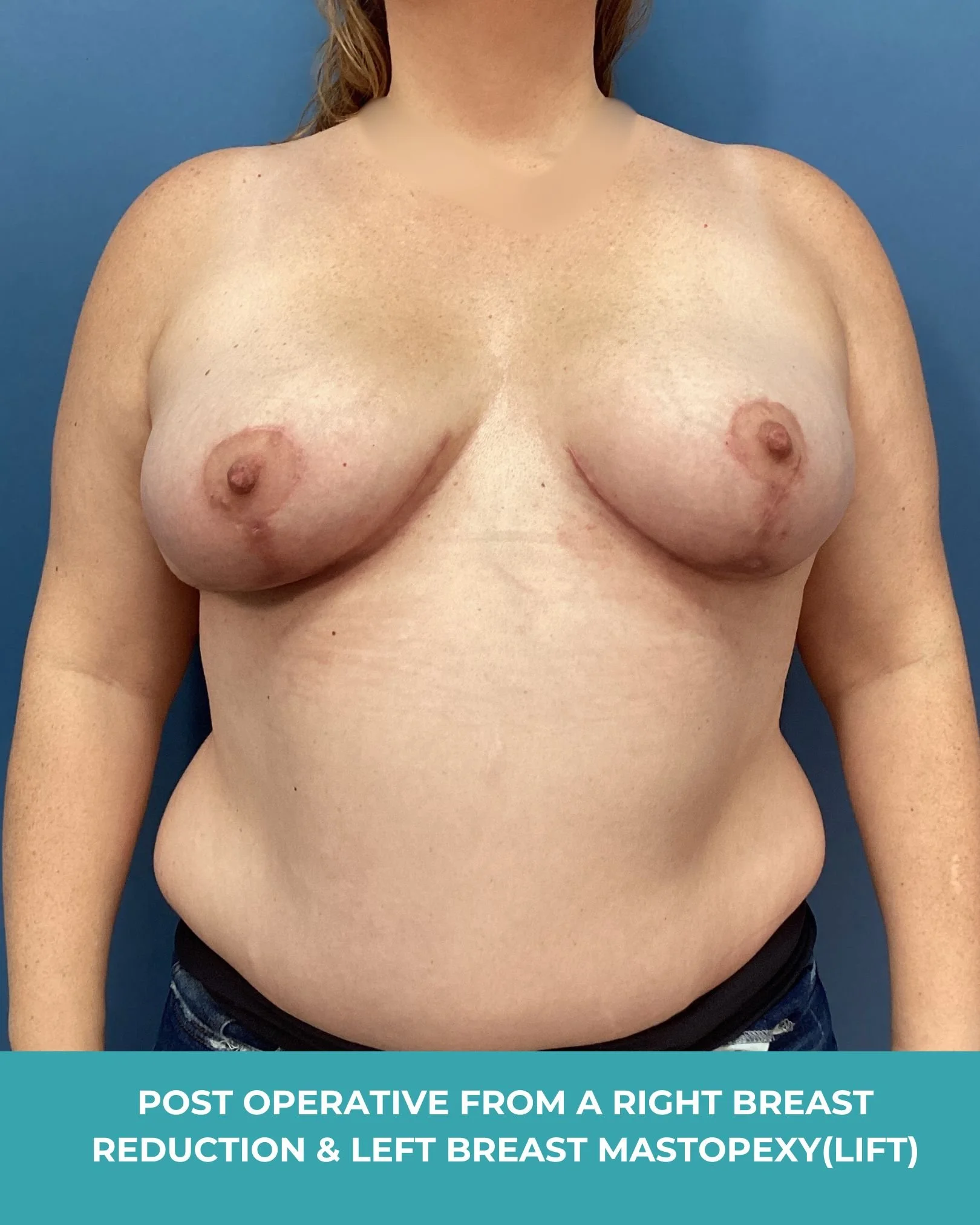 B&A R breast reduction L breast lift (2).jpg
