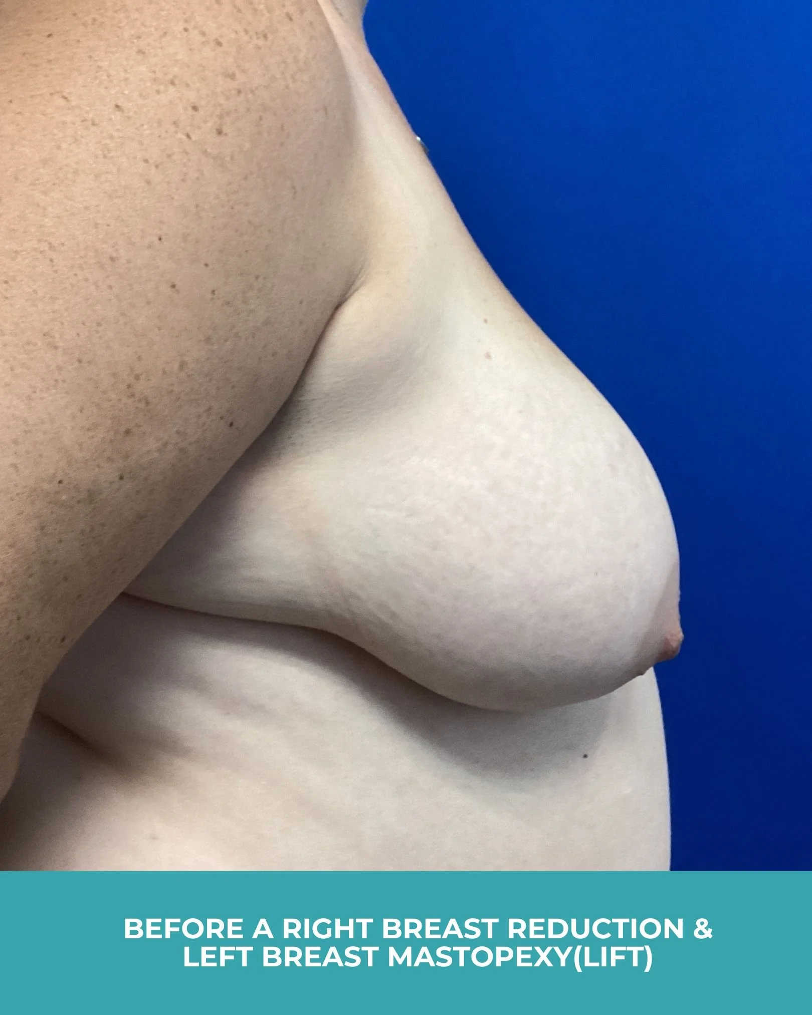 B&A R breast reduction L breast lift (5).jpg