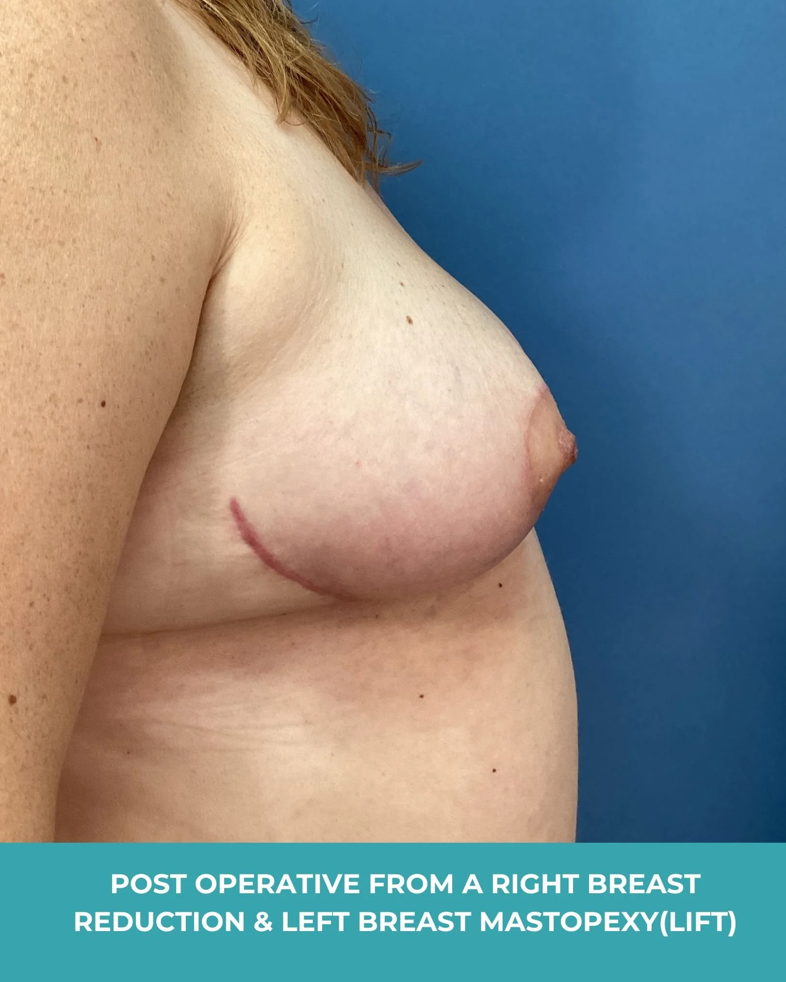 B&A R breast reduction L breast lift (6).jpg