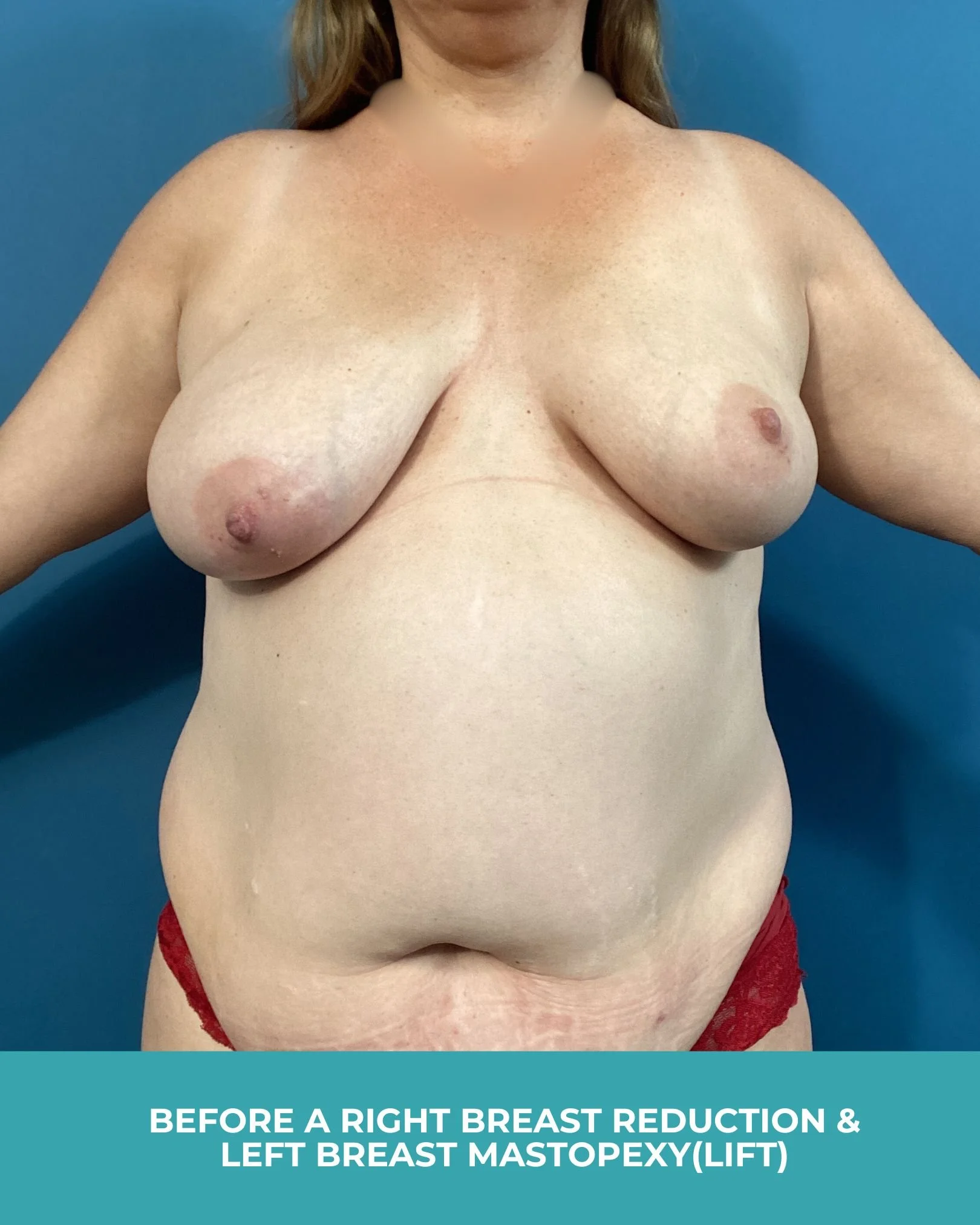 B&A R breast reduction L breast lift.jpg