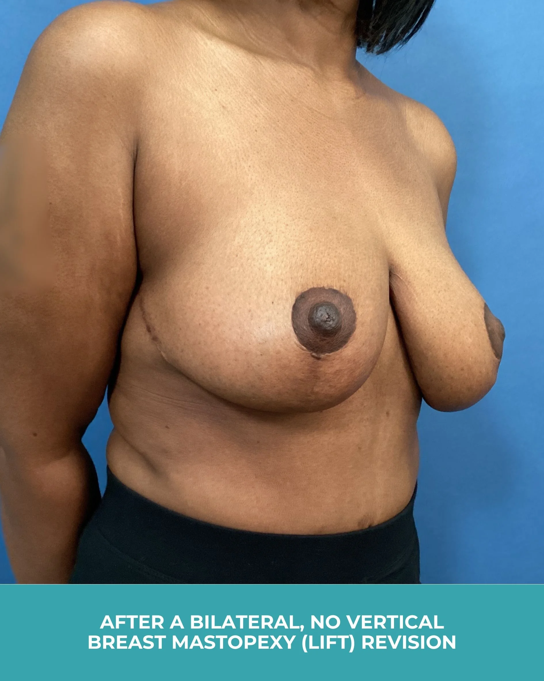 B&A Bilateral breast Mastopexy (lift) revision (4).jpg