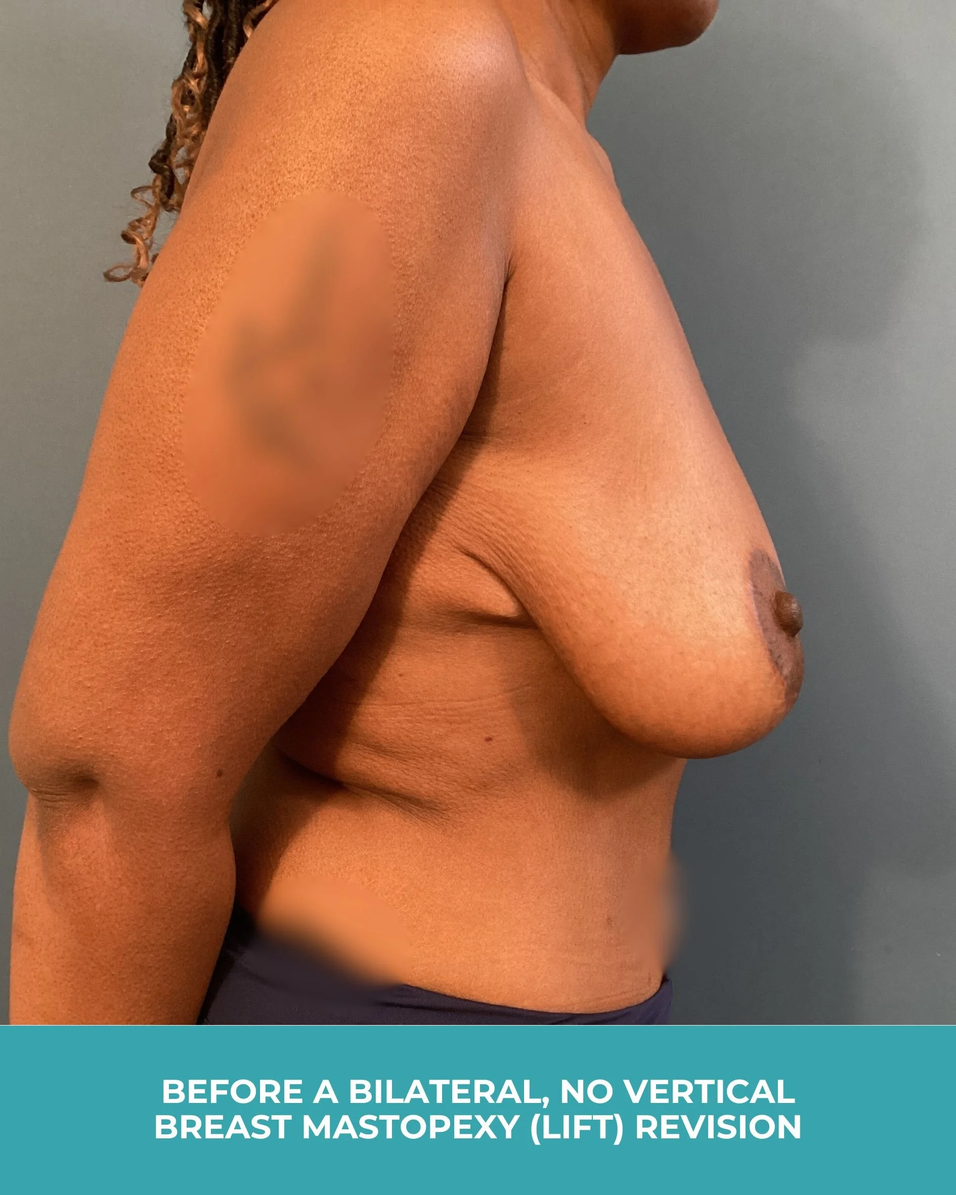 B&A Bilateral breast Mastopexy (lift) revision (5).jpg