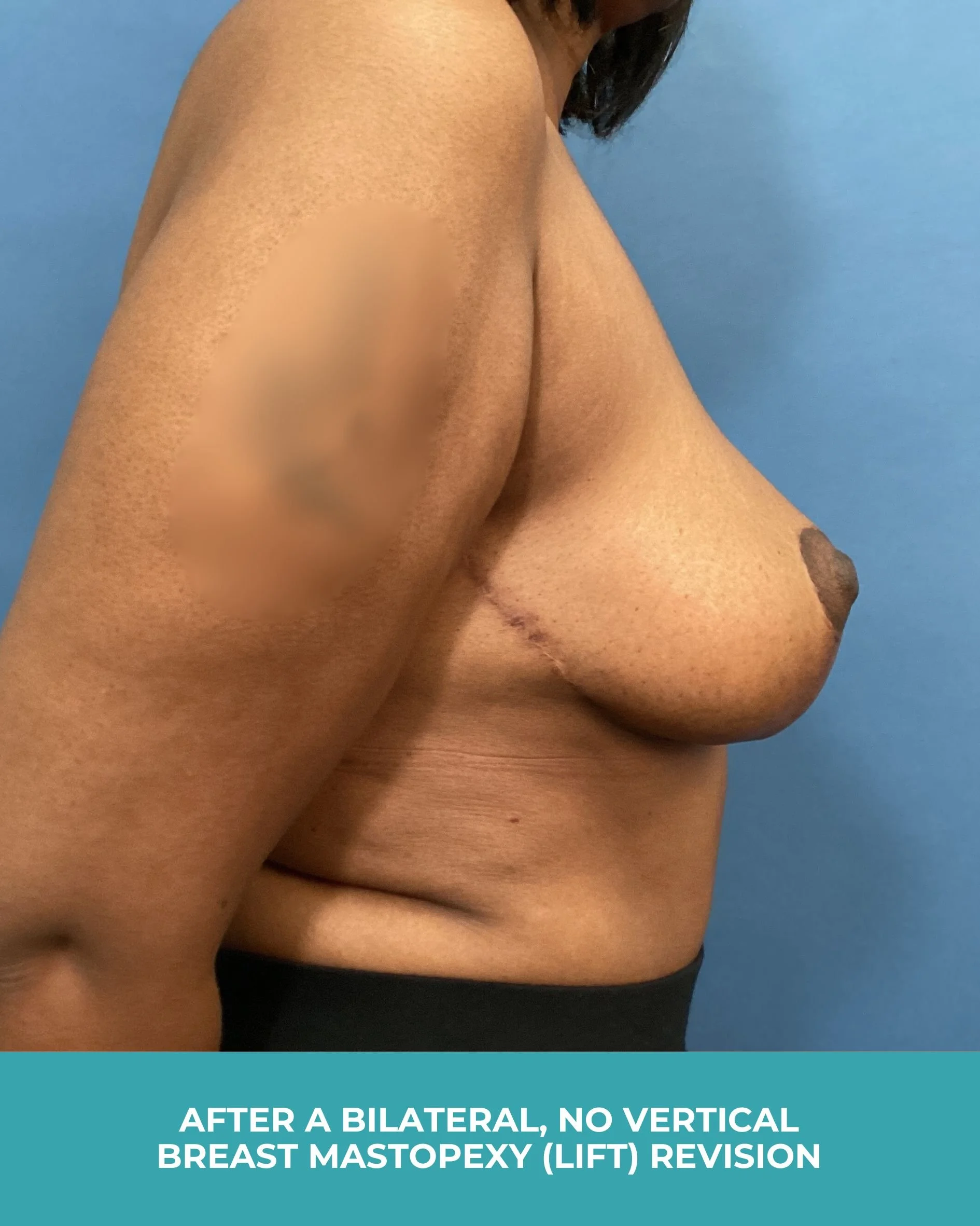 B&A Bilateral breast Mastopexy (lift) revision (6).jpg