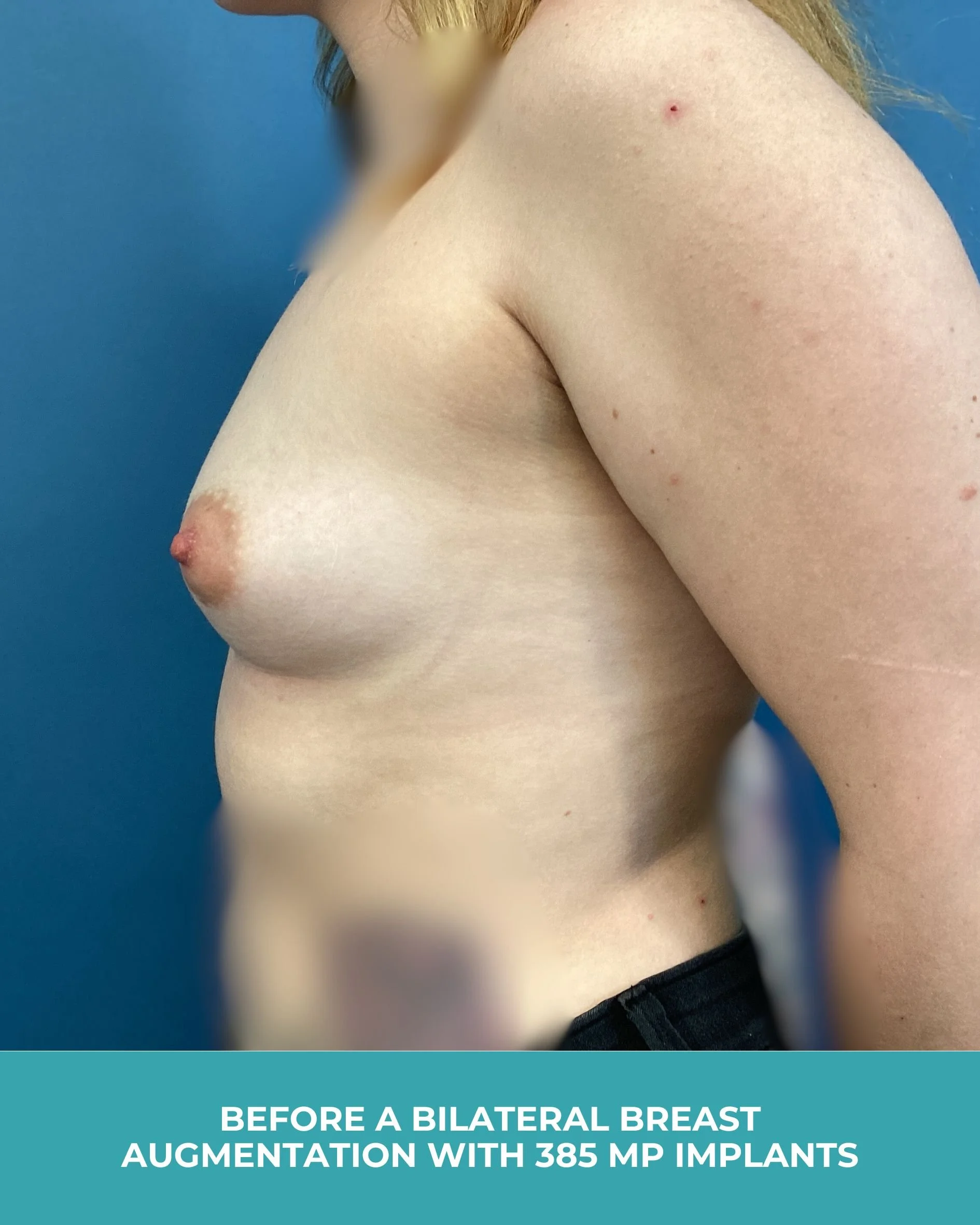 B&A Bilateral breast augmentation with 385 MP Implants (5).jpg
