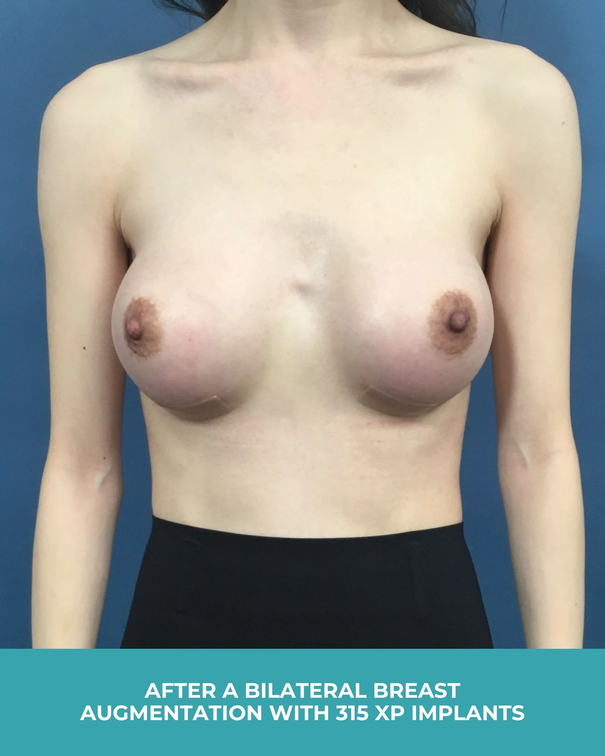 B&A Bilateral breast augmentation with 385 MP Implants (2).jpg
