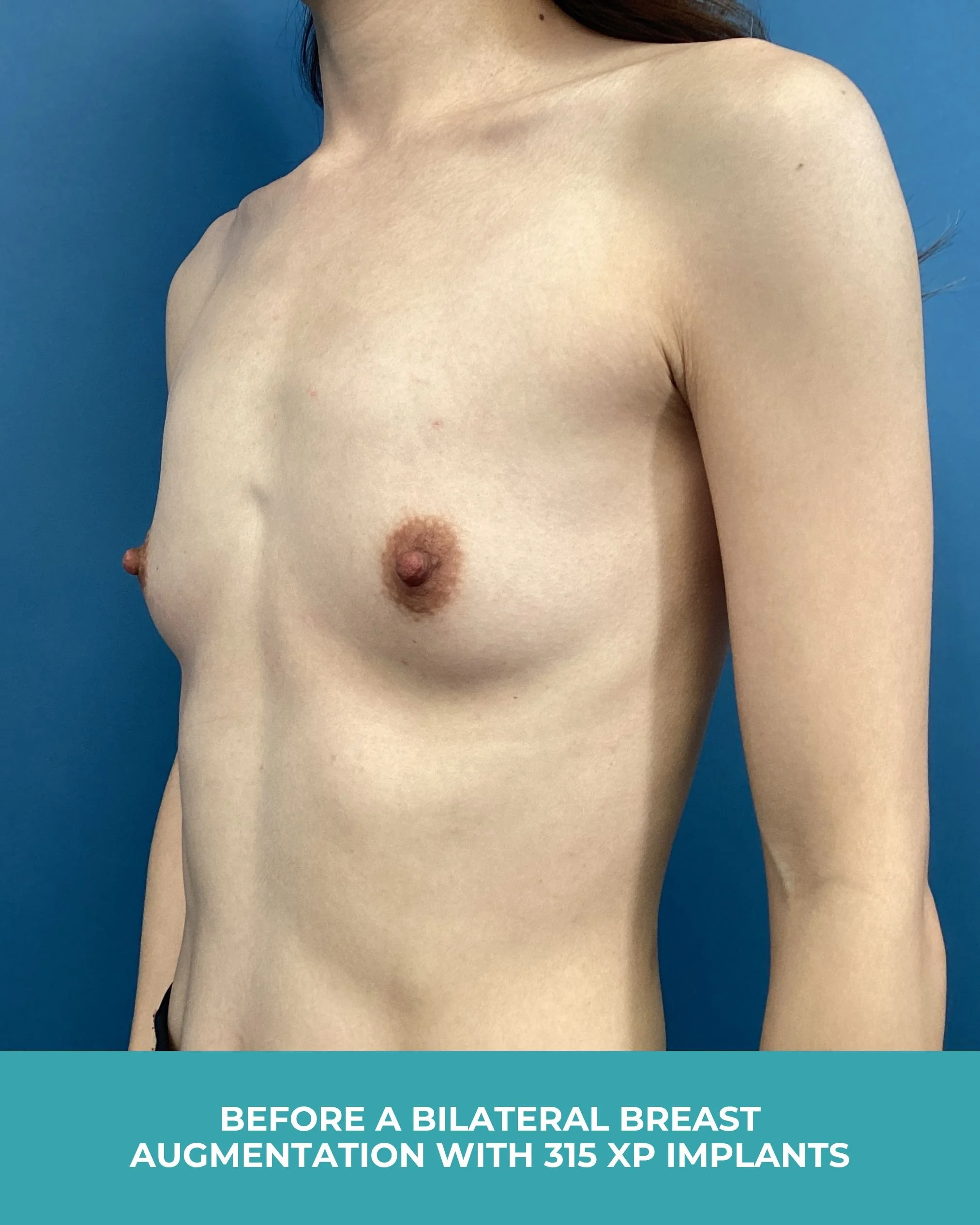 B&A Bilateral breast augmentation with 385 MP Implants (3).jpg