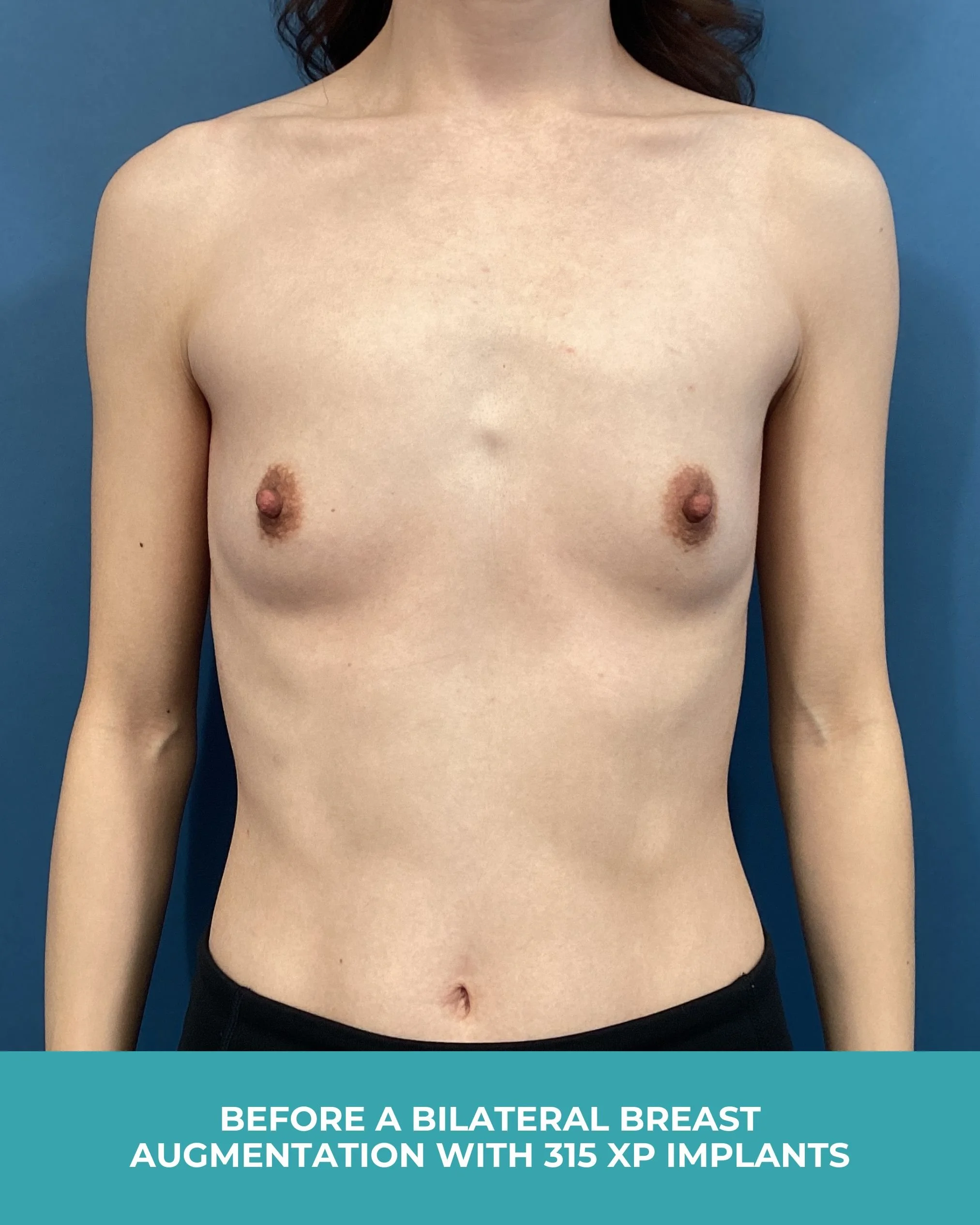 B&A Bilateral breast augmentation with 385 MP Implants.jpg