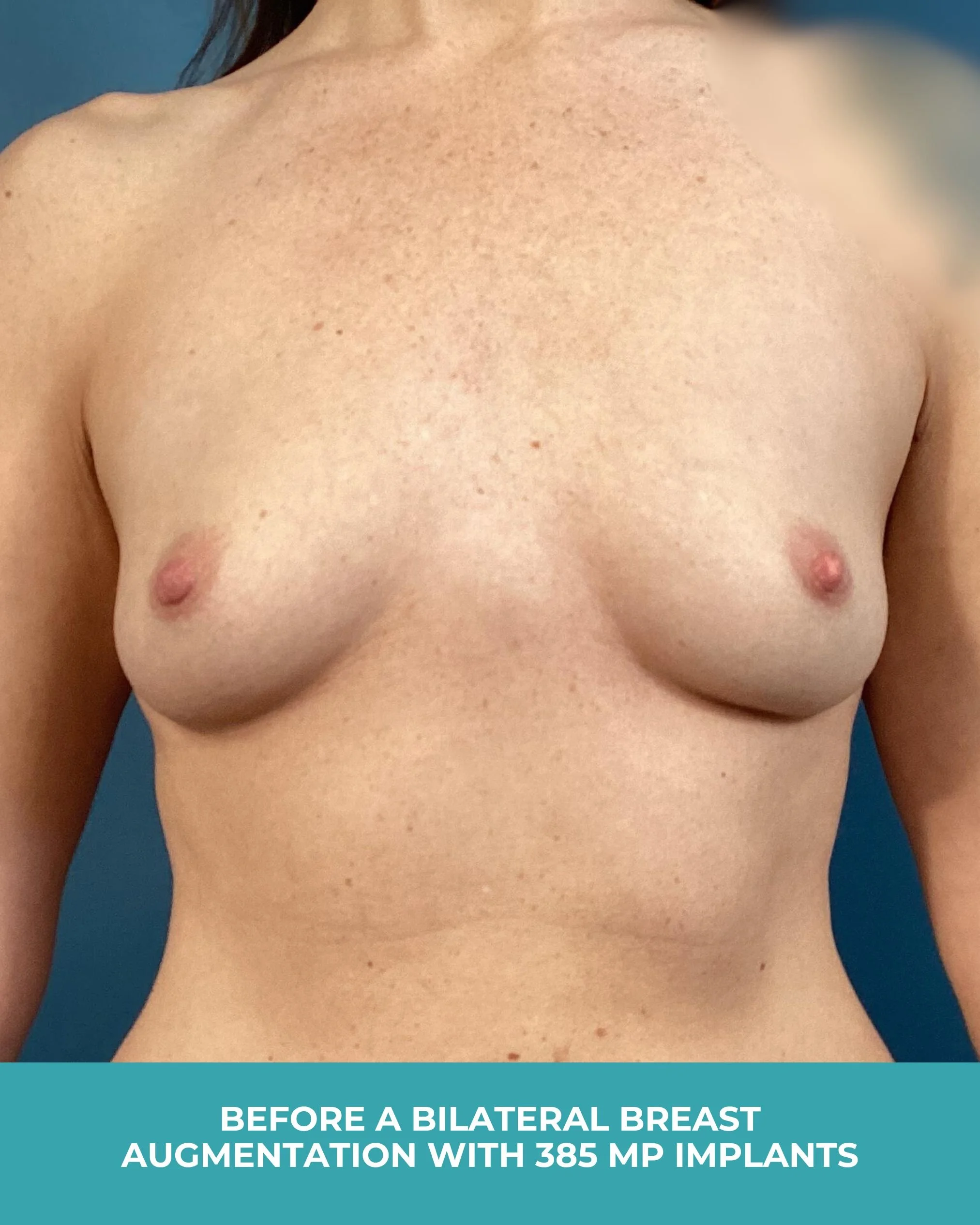 B&A Bilateral breast augmentation with 385 MP Implants.jpg