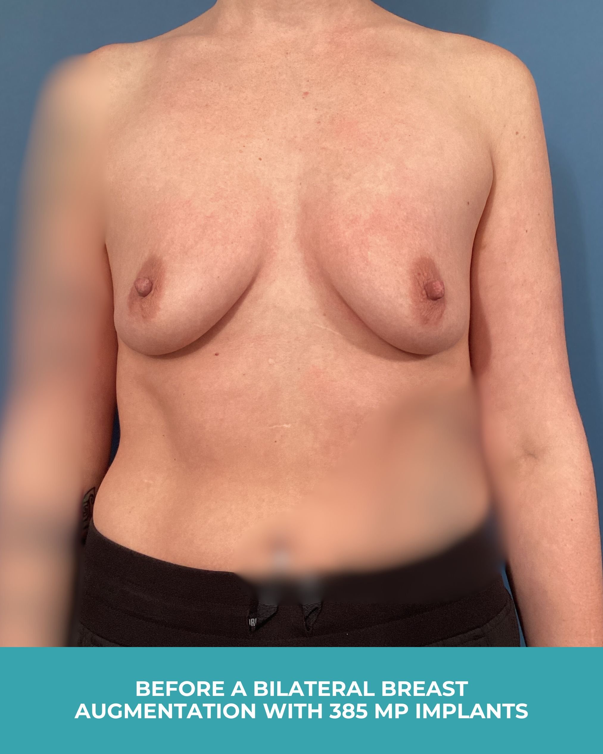 B&A Bilateral breast augmentation with 385 MP Implants.jpg