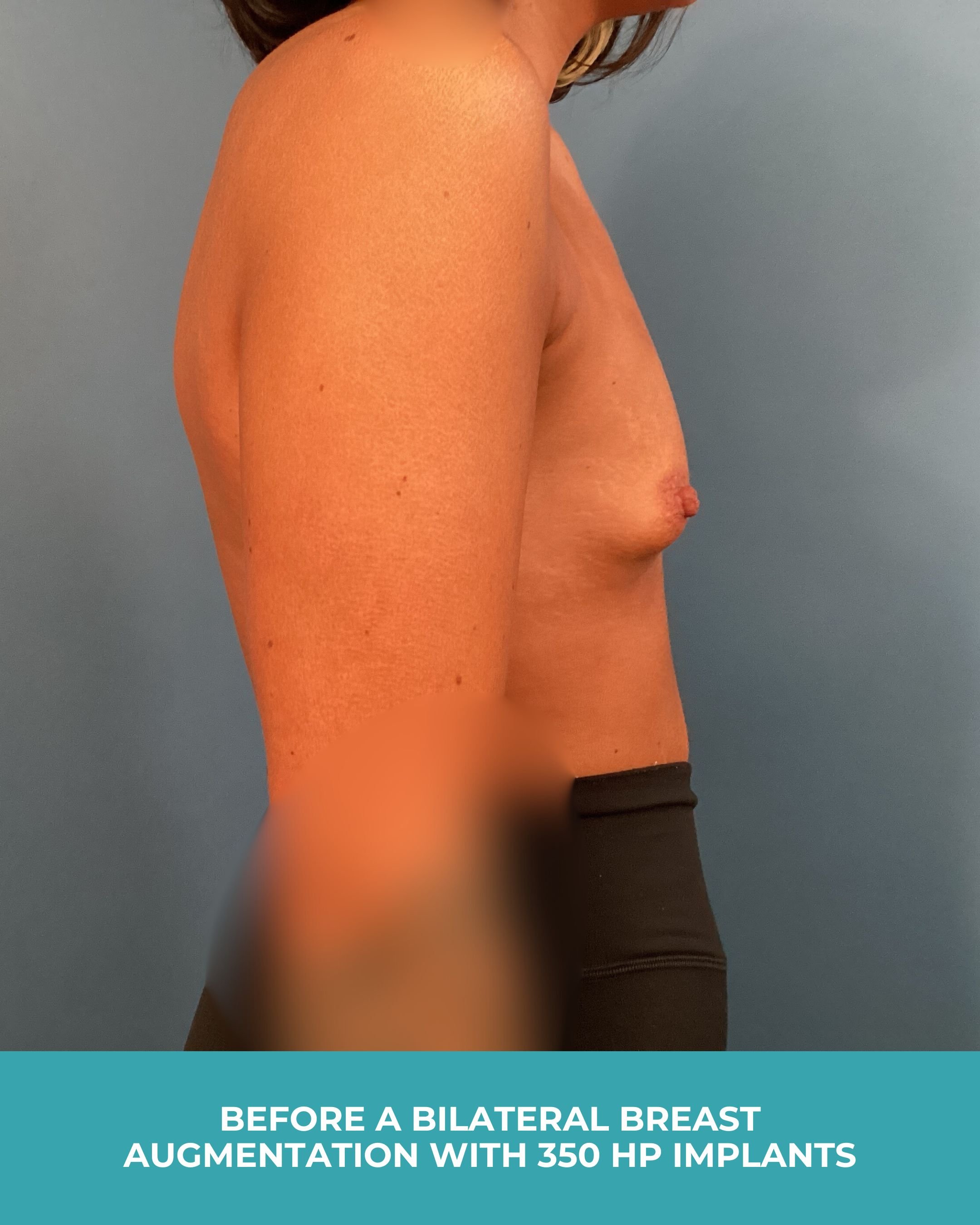 B&A Bilateral breast augmentation with 385 MP Implants (3).jpg