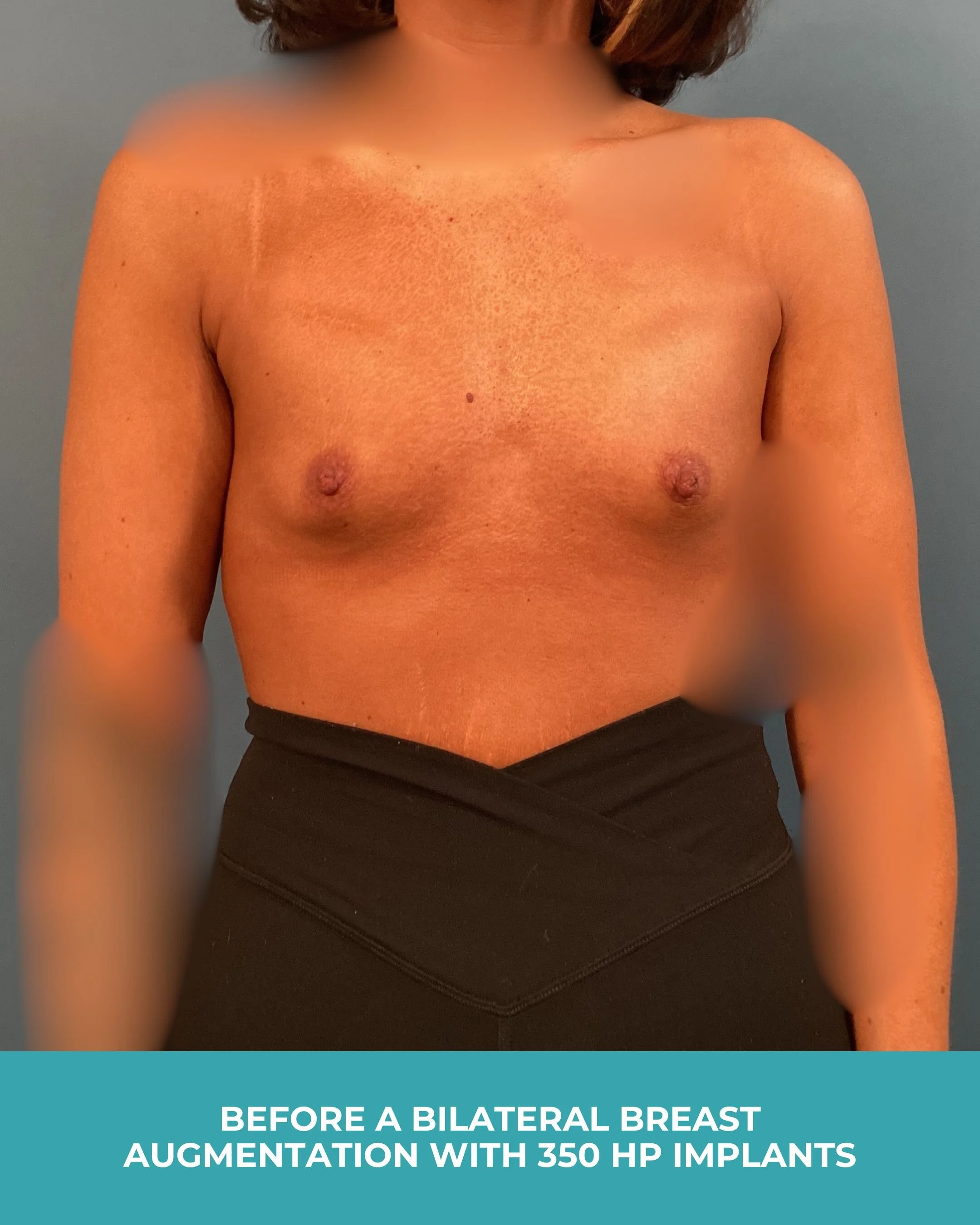 B&A Bilateral breast augmentation with 385 MP Implants.jpg