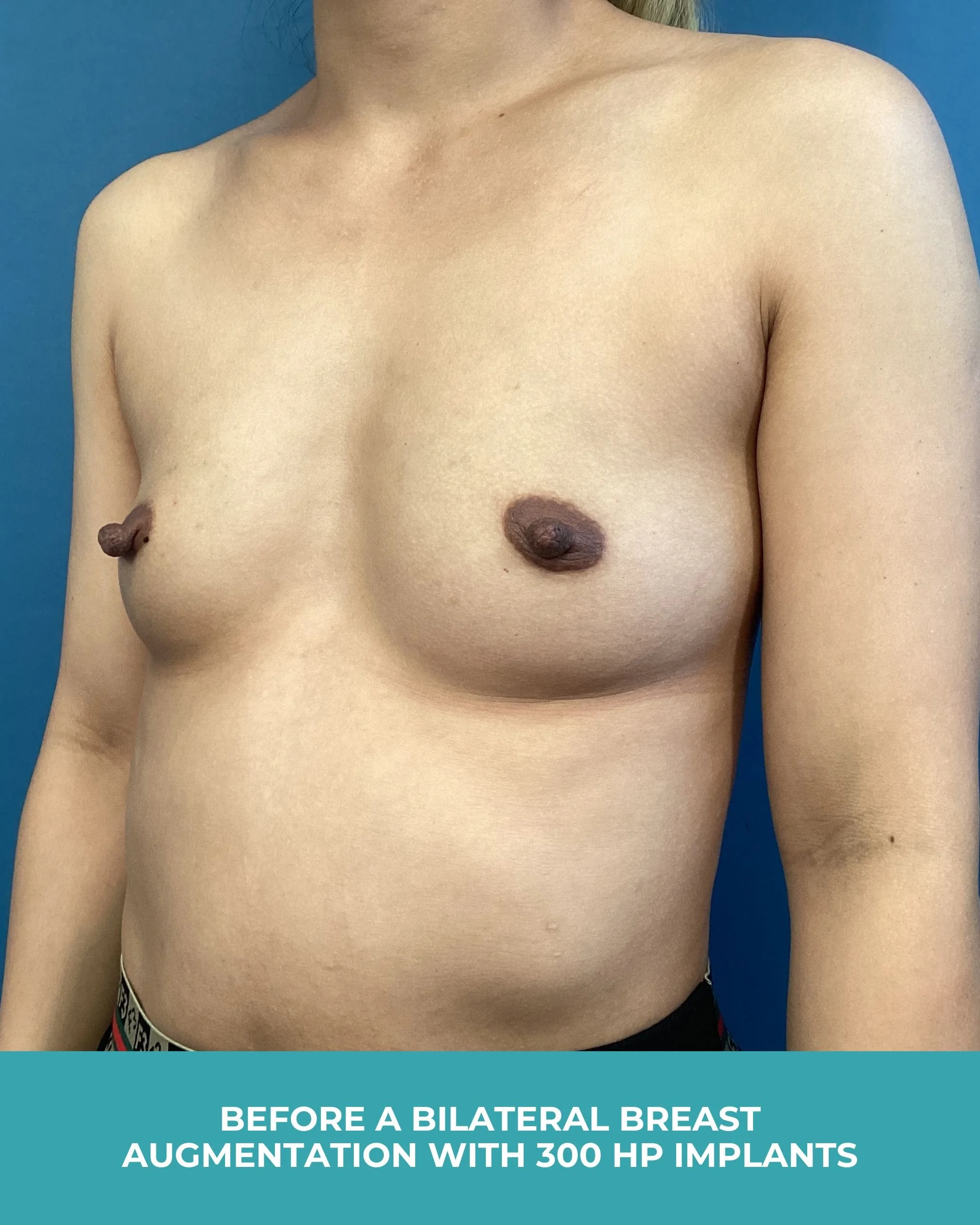 B&A Bilateral breast augmentation with 385 MP Implants (3).jpg