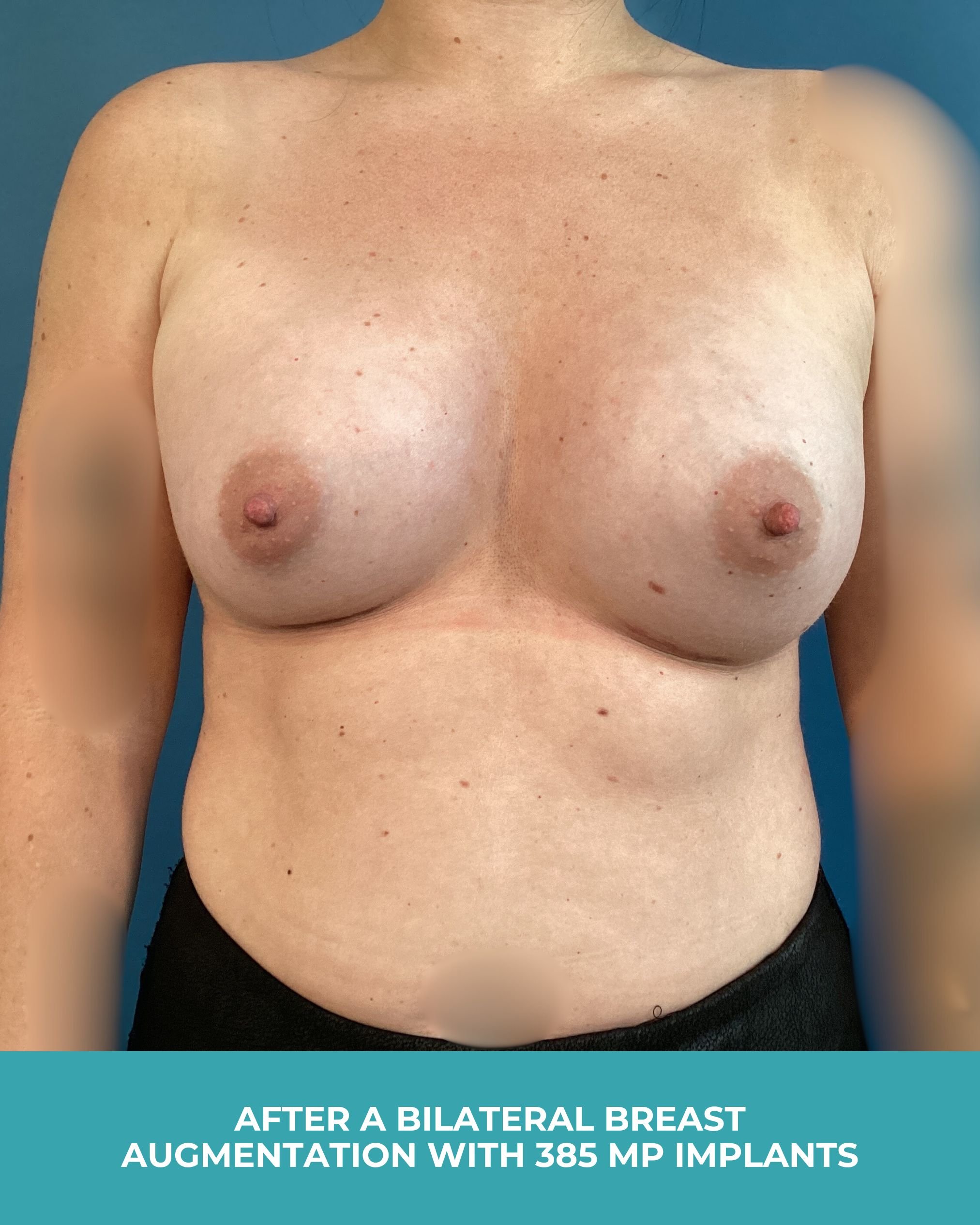 B&A Bilateral breast augmentation with 385 MP Implants (2).jpg