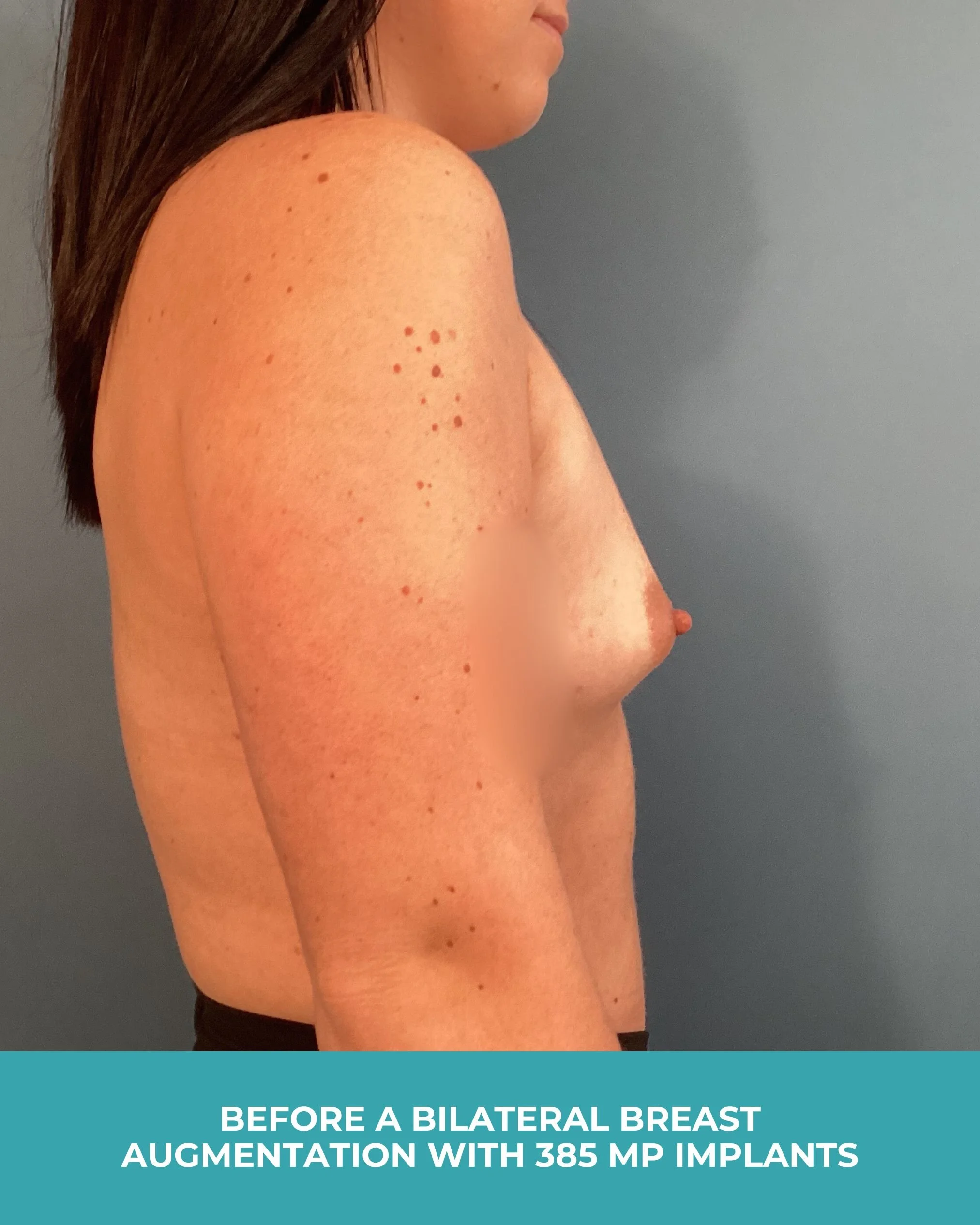 B&A Bilateral breast augmentation with 385 MP Implants (3).jpg