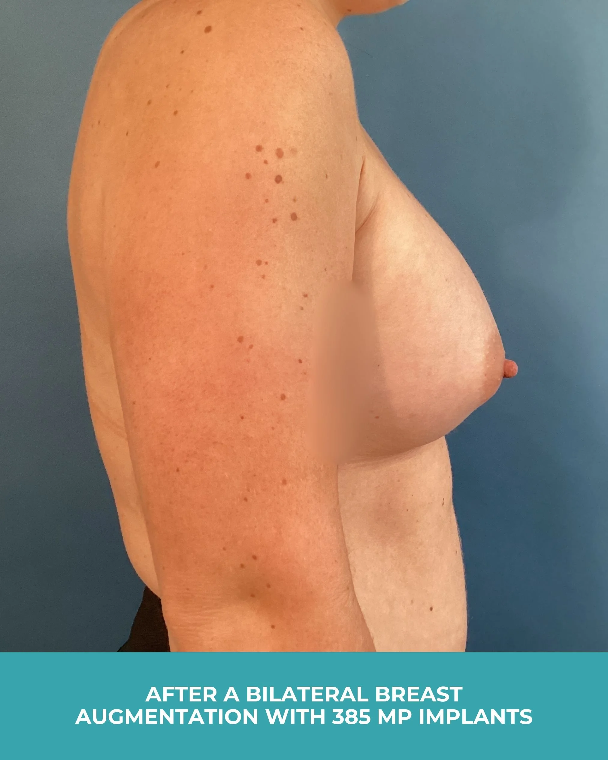 B&A Bilateral breast augmentation with 385 MP Implants (4).jpg