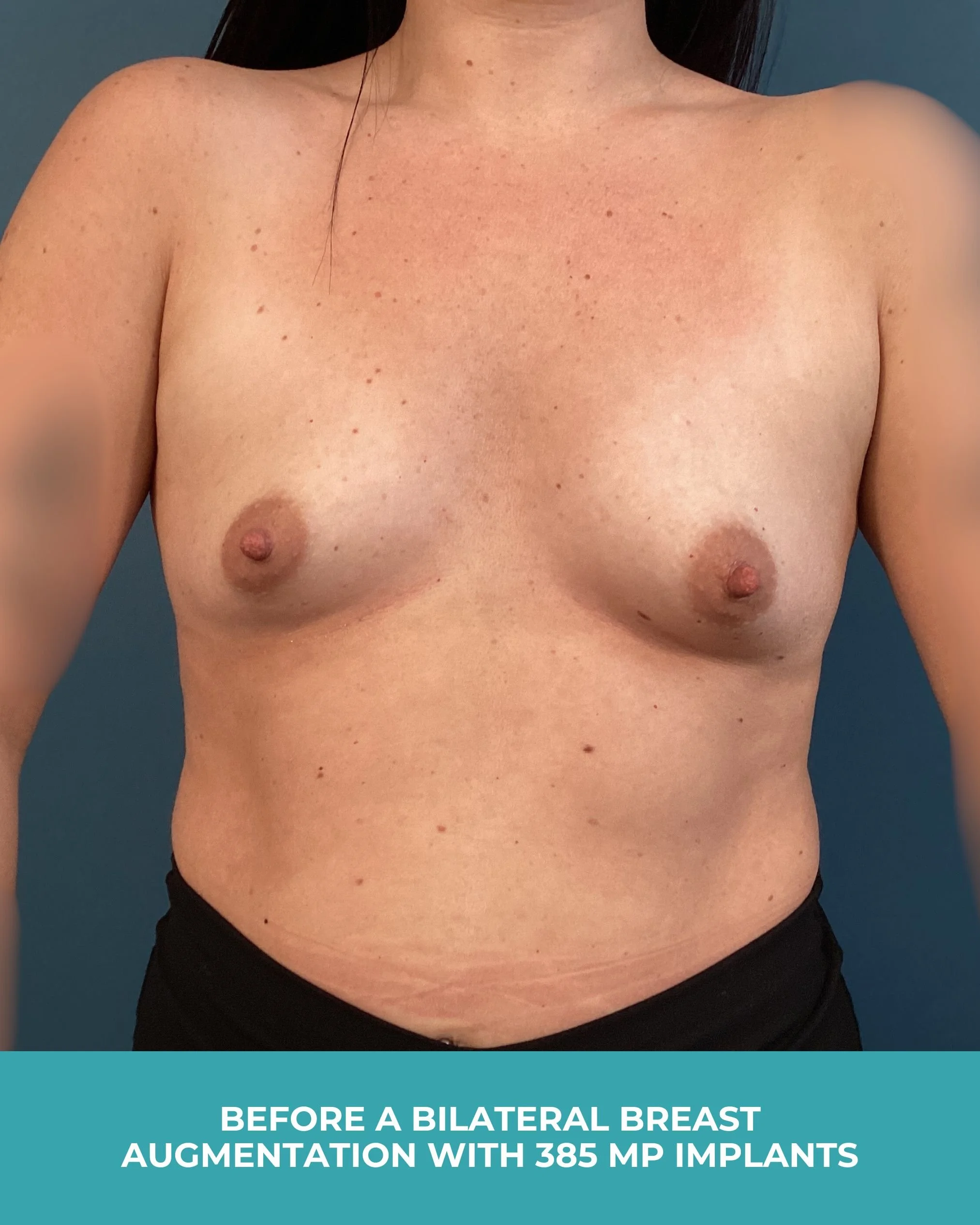 B&A Bilateral breast augmentation with 385 MP Implants.jpg