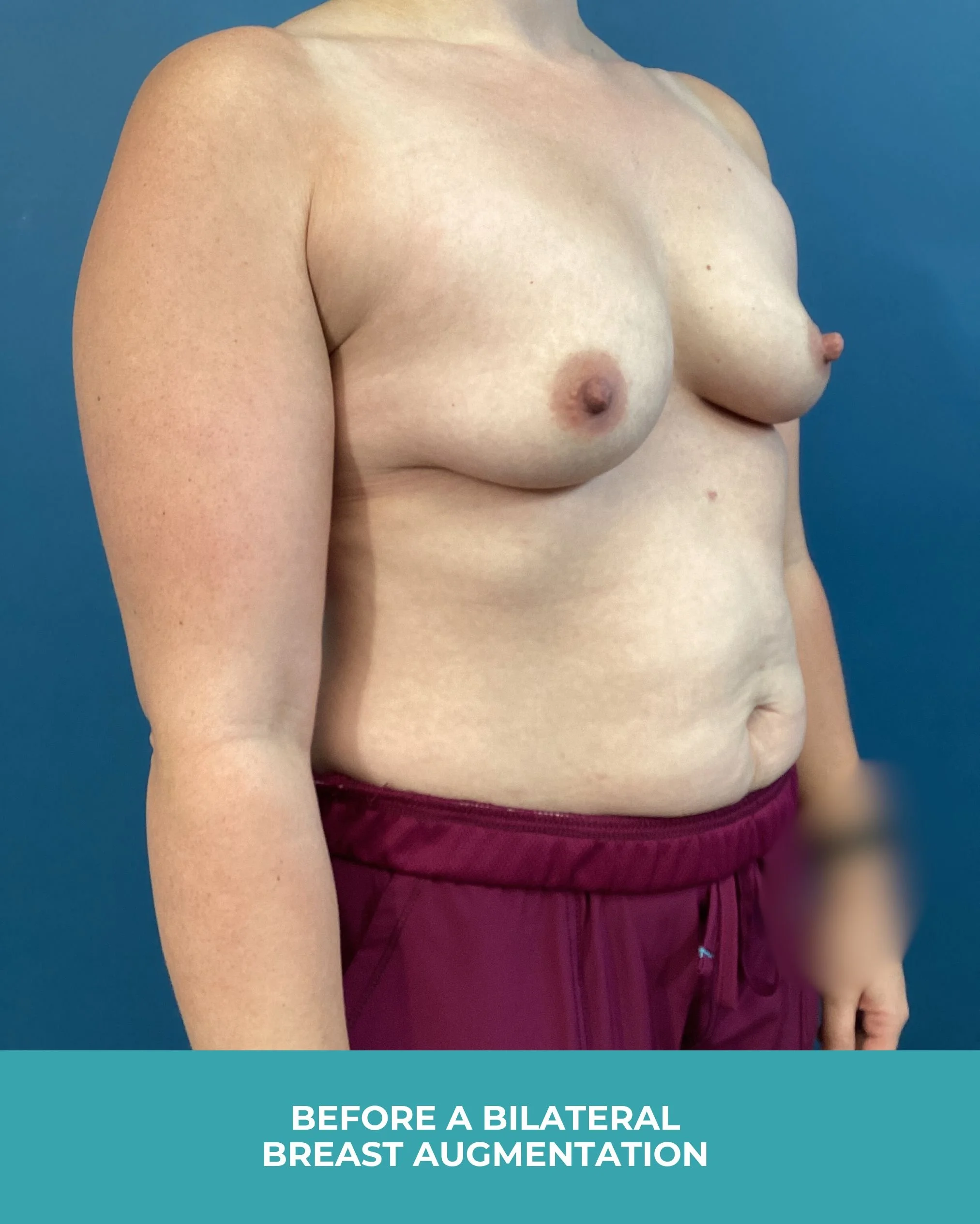 B&A Bilateral breast augmentation with 385 MP Implants (3).jpg