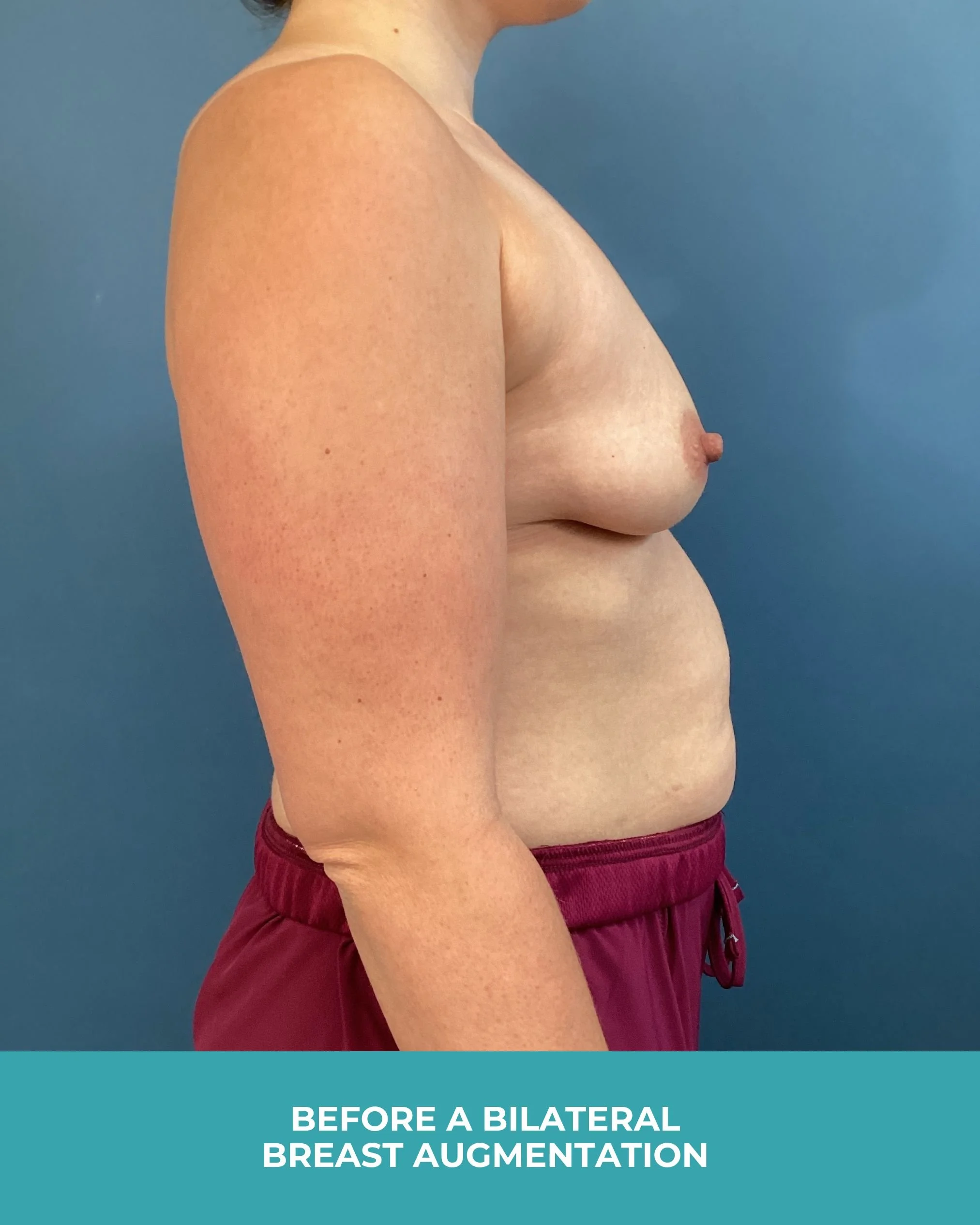 B&A Bilateral breast augmentation with 385 MP Implants (5).jpg