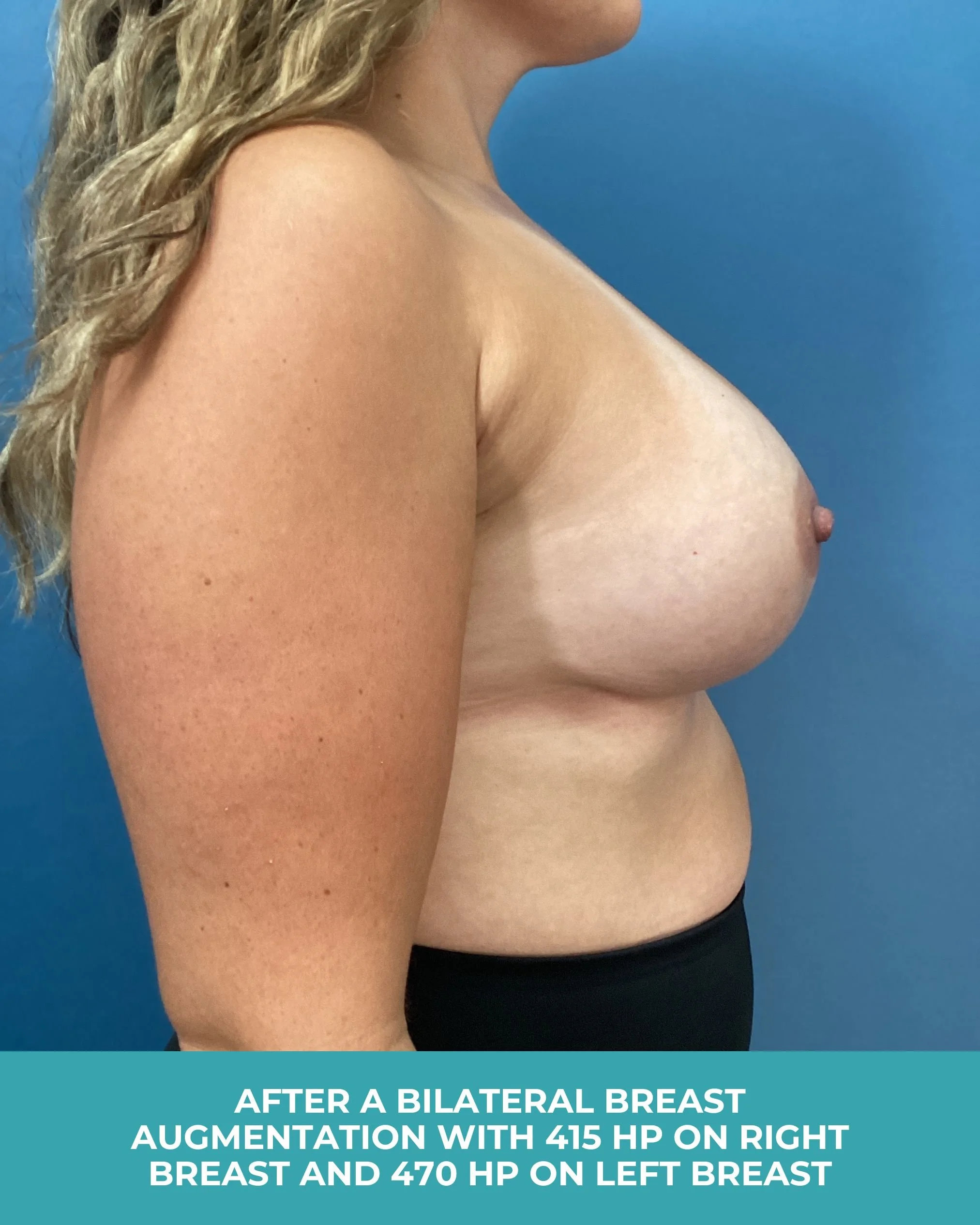 B&A Bilateral breast augmentation with 385 MP Implants (6).jpg