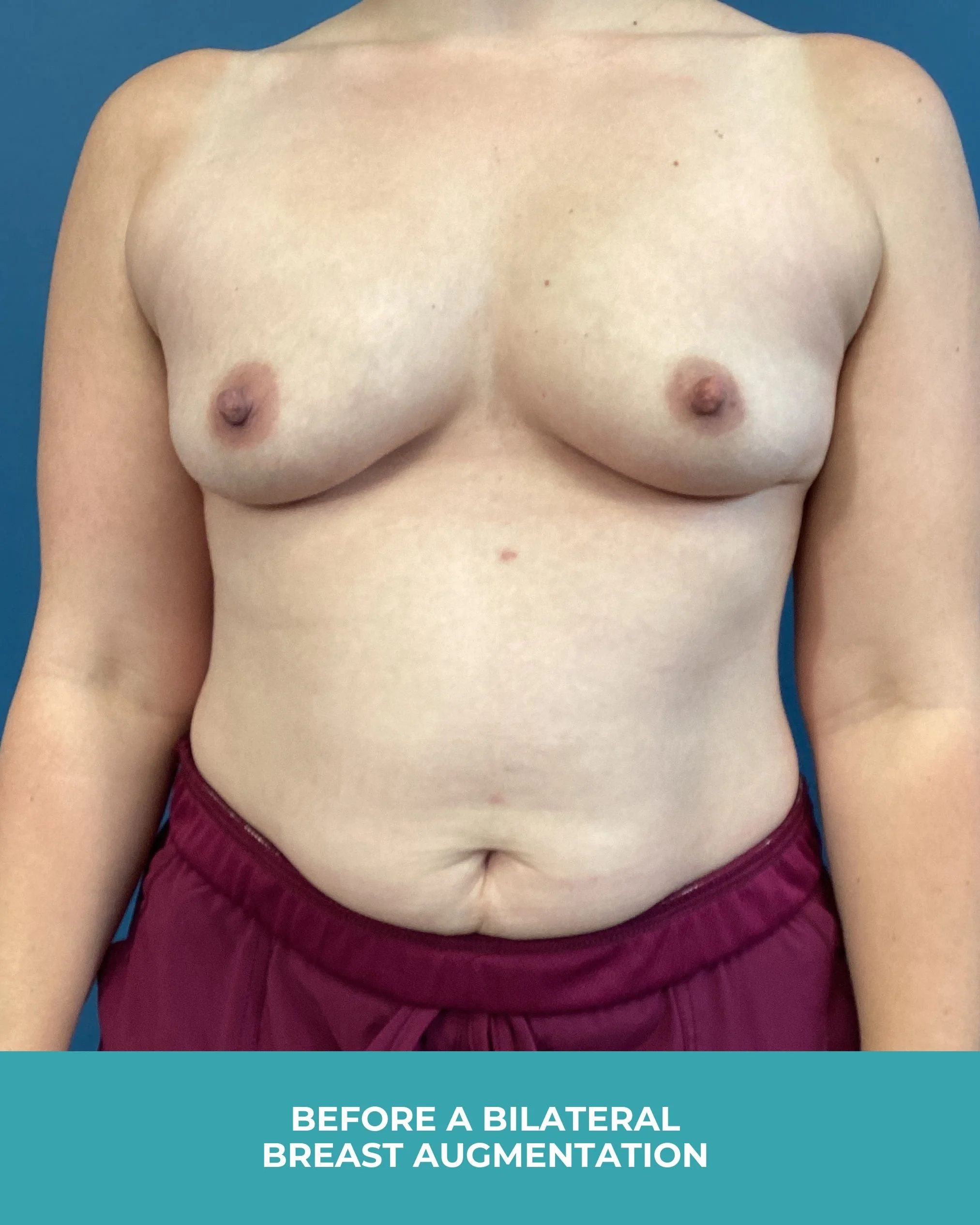 B&A Bilateral breast augmentation with 385 MP Implants.jpg