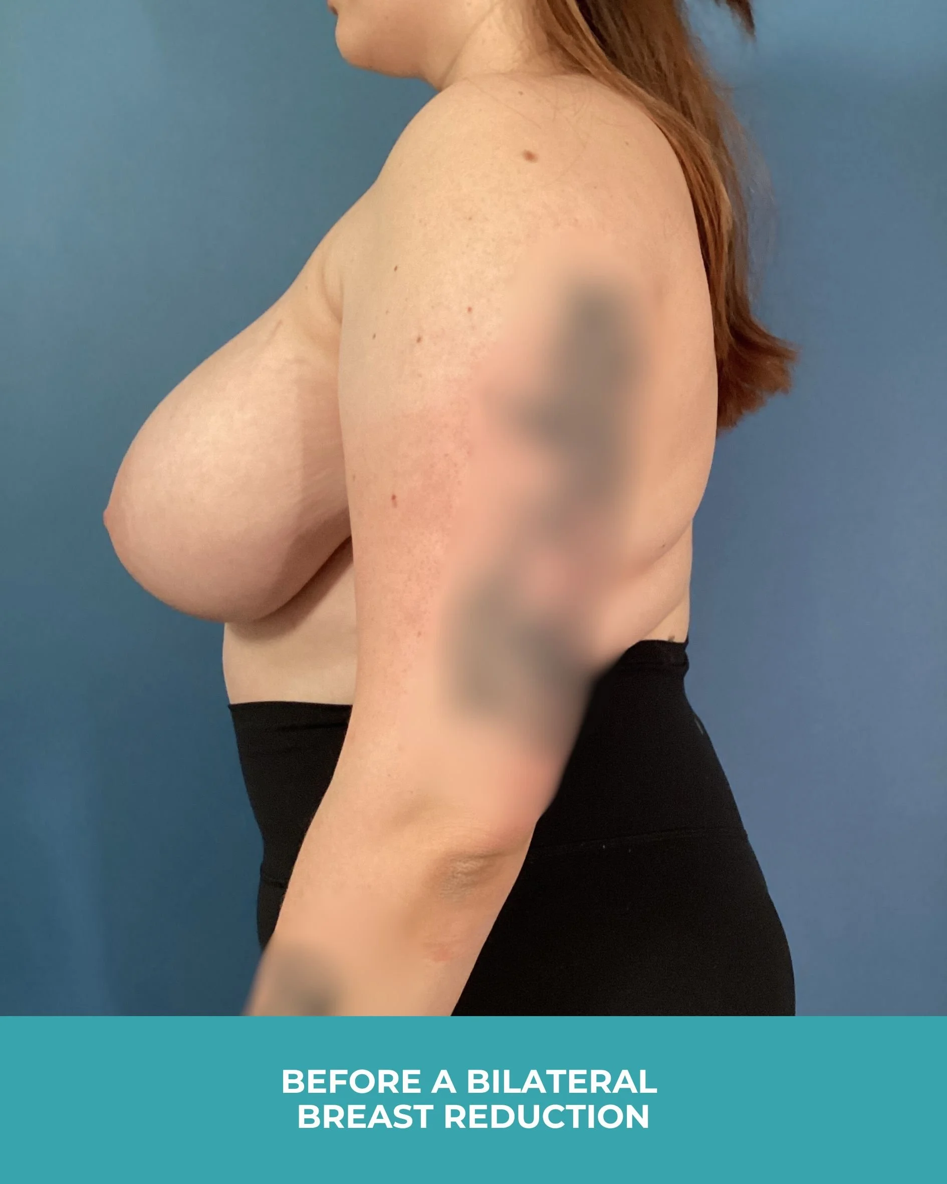 B&A Bilateral breast reduction (3).jpg